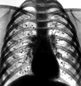Дифференциальная рентгенодиагностика заболеваний органов дыхания и средостения(часть 12)