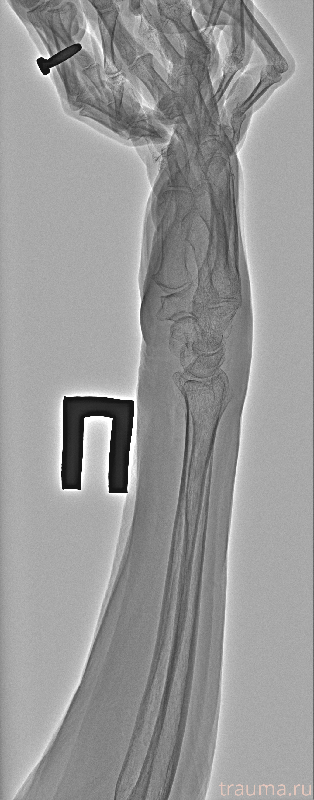 Рентген на дому: по вашему адресу приезжает врач-рентгенолог, травматолог-ортопед с мобильным рентгеновским аппаратом, проводит диагностику травмы или заболевания, делает необходимые рентгенограммы, дает рекомендации по дальнейшему лечению. Получить качественные снимки в домашних условиях возможно благодаря уникальной методике, разработанной МосРентген Центром для института  Склифосовского