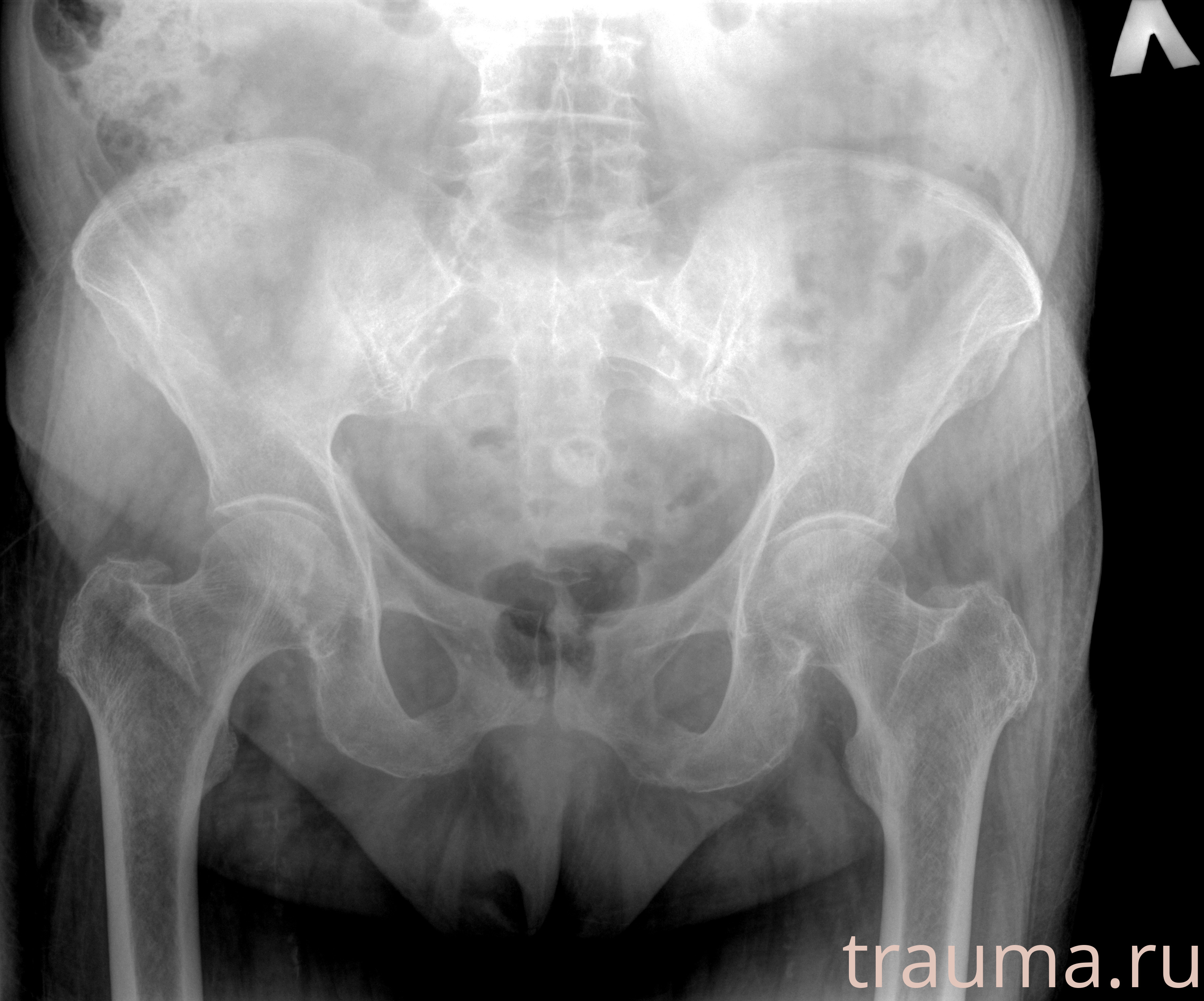 Рентген на дому: по вашему адресу приезжает врач-рентгенолог, травматолог-ортопед с мобильным рентгеновским аппаратом, проводит диагностику травмы или заболевания, делает необходимые рентгенограммы, дает рекомендации по дальнейшему лечению. Получить качественные снимки в домашних условиях возможно благодаря уникальной методике, разработанной МосРентген Центром для института  Склифосовского