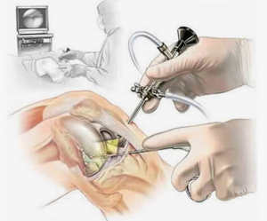 Результат лечения пациентки с инфекцией коленного сустава после артроскопической пластики передней крестообразной связки