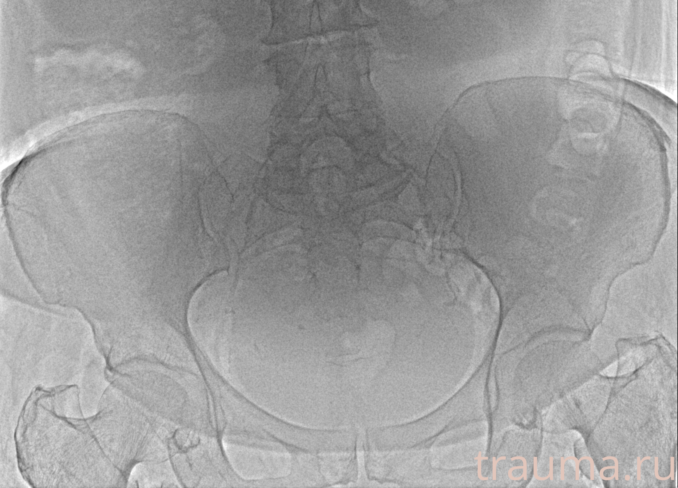 Рентген на дому: по вашему адресу приезжает врач-рентгенолог, травматолог-ортопед с мобильным рентгеновским аппаратом, проводит диагностику травмы или заболевания, делает необходимые рентгенограммы, дает рекомендации по дальнейшему лечению. Получить качественные снимки в домашних условиях возможно благодаря уникальной методике, разработанной МосРентген Центром для института  Склифосовского