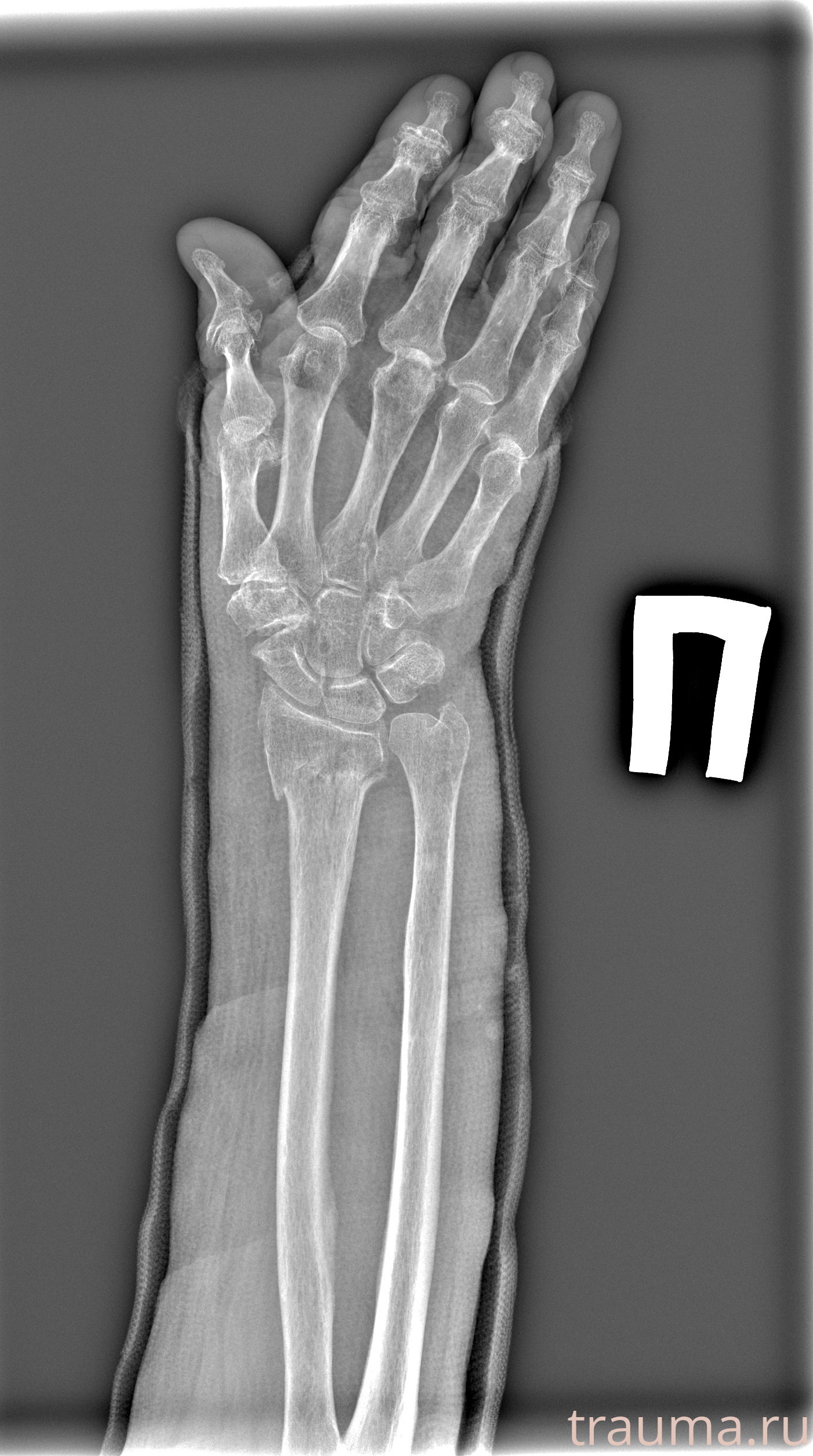 Рентген на дому: по вашему адресу приезжает врач-рентгенолог, травматолог-ортопед с мобильным рентгеновским аппаратом, проводит диагностику травмы или заболевания, делает необходимые рентгенограммы, дает рекомендации по дальнейшему лечению. Получить качественные снимки в домашних условиях возможно благодаря уникальной методике, разработанной МосРентген Центром для института  Склифосовского