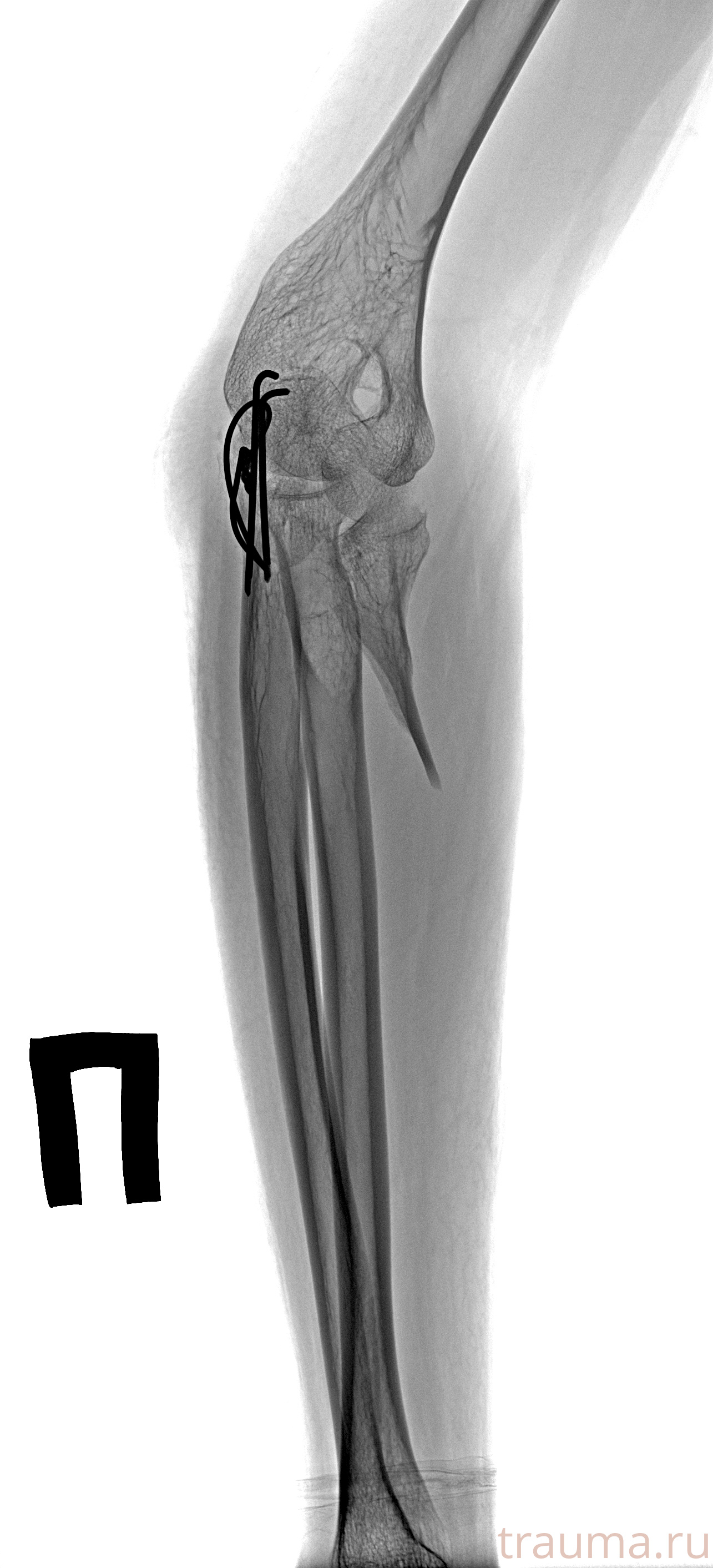 Рентген на дому: по вашему адресу приезжает врач-рентгенолог, травматолог-ортопед с мобильным рентгеновским аппаратом, проводит диагностику травмы или заболевания, делает необходимые рентгенограммы, дает рекомендации по дальнейшему лечению. Получить качественные снимки в домашних условиях возможно благодаря уникальной методике, разработанной МосРентген Центром для института  Склифосовского