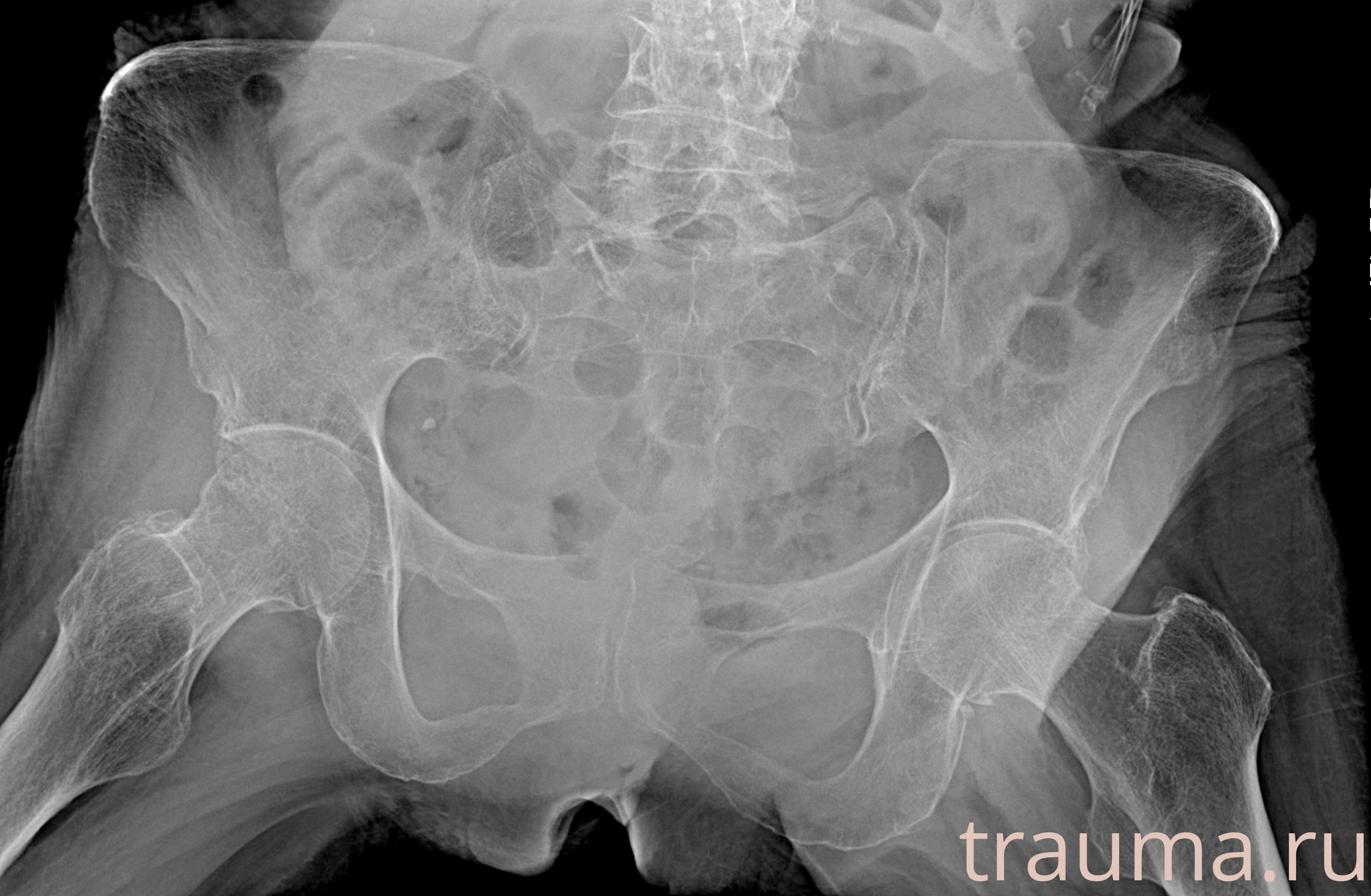 Рентген на дому: по вашему адресу приезжает врач-рентгенолог, травматолог-ортопед с мобильным рентгеновским аппаратом, проводит диагностику травмы или заболевания, делает необходимые рентгенограммы, дает рекомендации по дальнейшему лечению. Получить качественные снимки в домашних условиях возможно благодаря уникальной методике, разработанной МосРентген Центром для института  Склифосовского