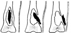 Замещение остаточных костных полостей после некрсеквестрэктомии при хроническом остеомиелите 