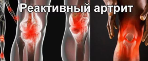 Реактивный артрит Реактивный артрит