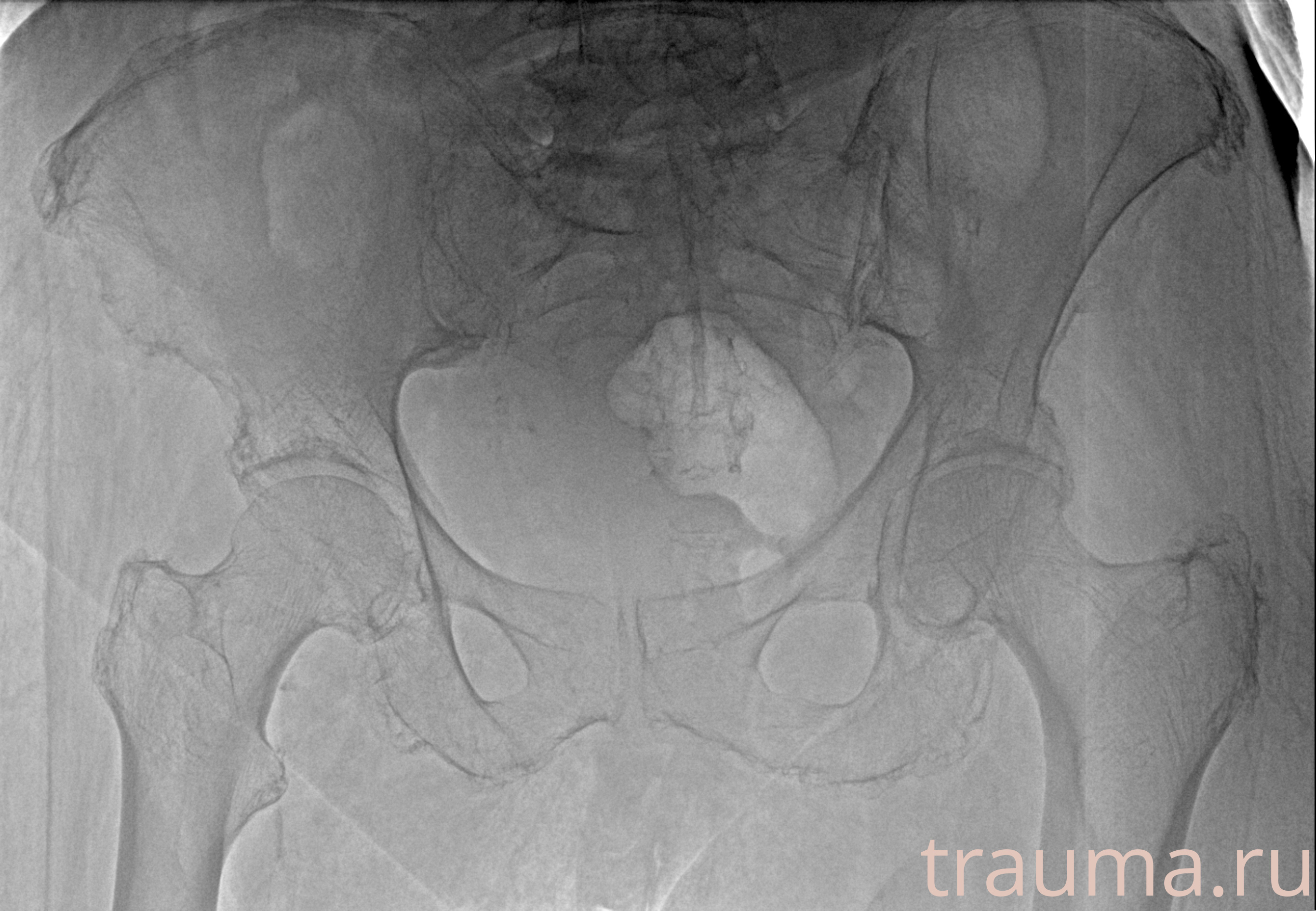 Рентген на дому: по вашему адресу приезжает врач-рентгенолог, травматолог-ортопед с мобильным рентгеновским аппаратом, проводит диагностику травмы или заболевания, делает необходимые рентгенограммы, дает рекомендации по дальнейшему лечению. Получить качественные снимки в домашних условиях возможно благодаря уникальной методике, разработанной МосРентген Центром для института  Склифосовского