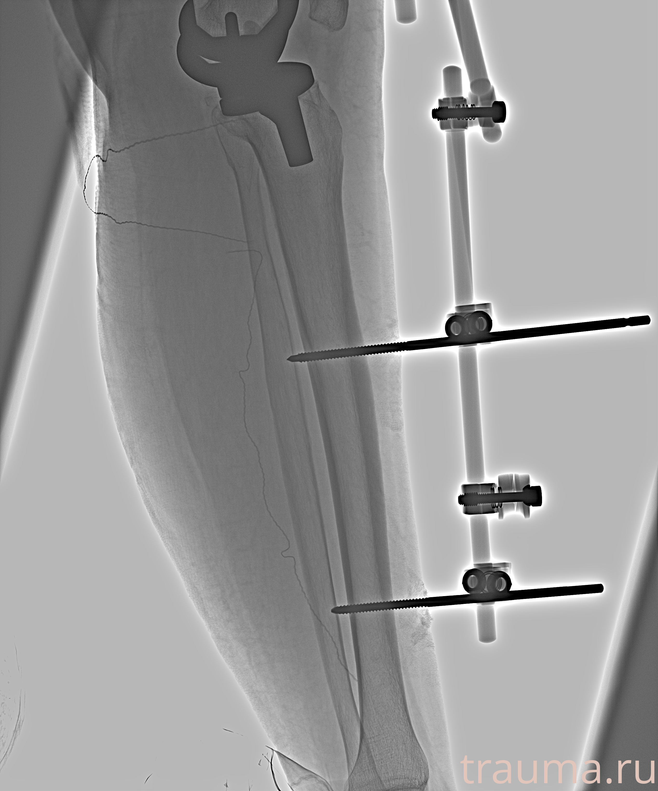 Рентген на дому: по вашему адресу приезжает врач-рентгенолог, травматолог-ортопед с мобильным рентгеновским аппаратом, проводит диагностику травмы или заболевания, делает необходимые рентгенограммы, дает рекомендации по дальнейшему лечению. Получить качественные снимки в домашних условиях возможно благодаря уникальной методике, разработанной МосРентген Центром для института  Склифосовского