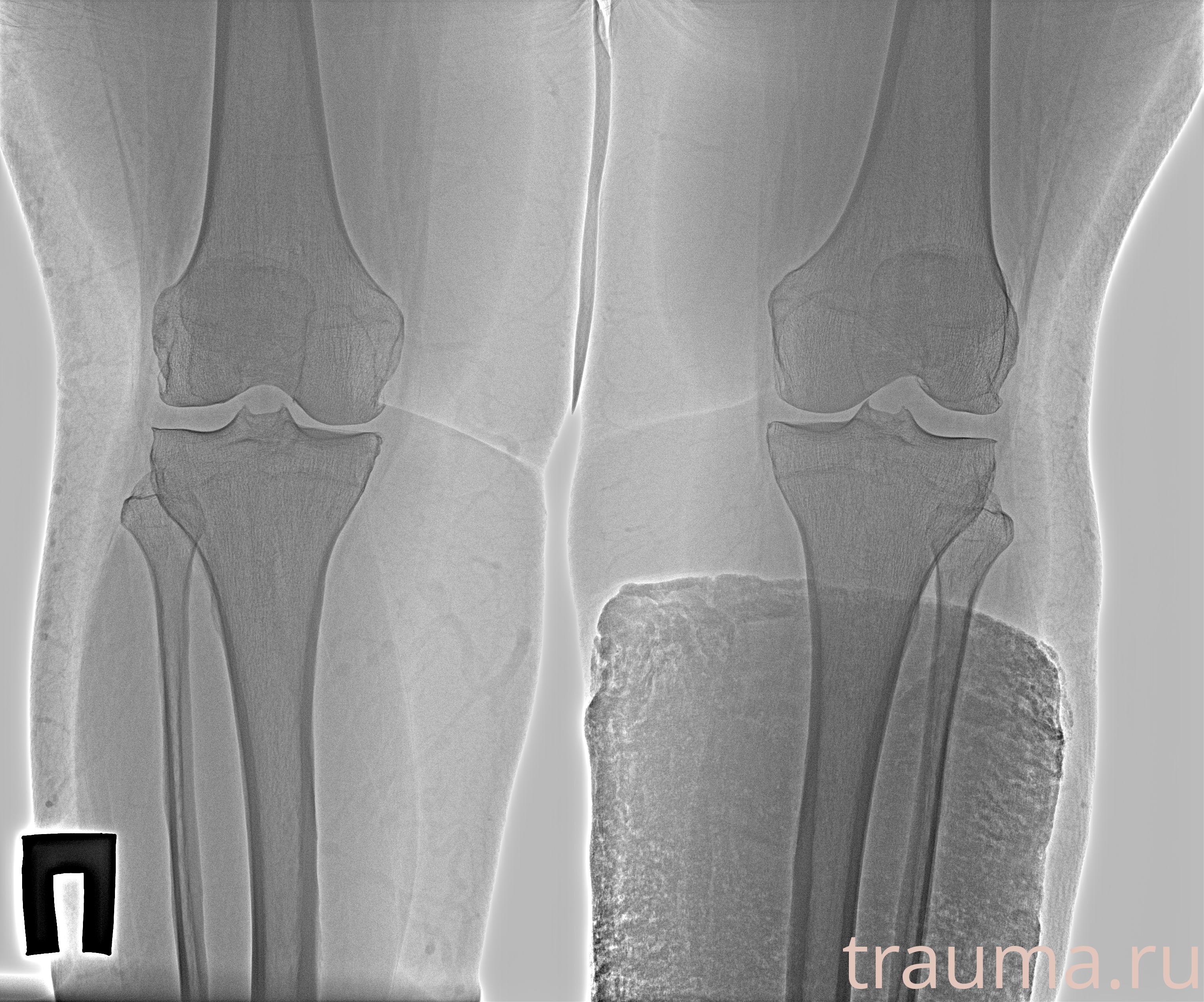 Рентген на дому: по вашему адресу приезжает врач-рентгенолог, травматолог-ортопед с мобильным рентгеновским аппаратом, проводит диагностику травмы или заболевания, делает необходимые рентгенограммы, дает рекомендации по дальнейшему лечению. Получить качественные снимки в домашних условиях возможно благодаря уникальной методике, разработанной МосРентген Центром для института  Склифосовского