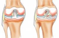 Диагностика и лечение хронической задней нестабильности коленного сустава