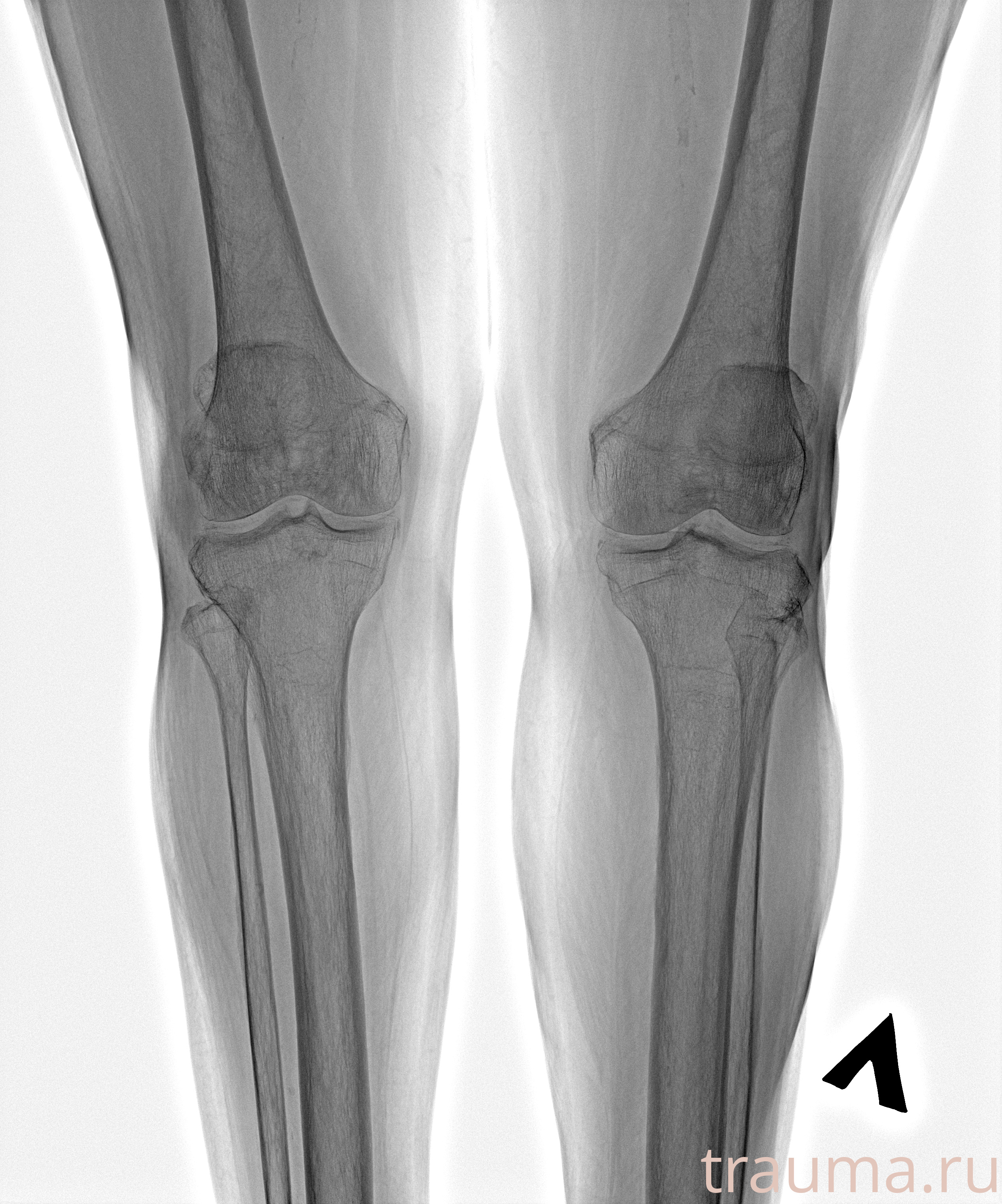Рентген на дому: по вашему адресу приезжает врач-рентгенолог, травматолог-ортопед с мобильным рентгеновским аппаратом, проводит диагностику травмы или заболевания, делает необходимые рентгенограммы, дает рекомендации по дальнейшему лечению. Получить качественные снимки в домашних условиях возможно благодаря уникальной методике, разработанной МосРентген Центром для института  Склифосовского