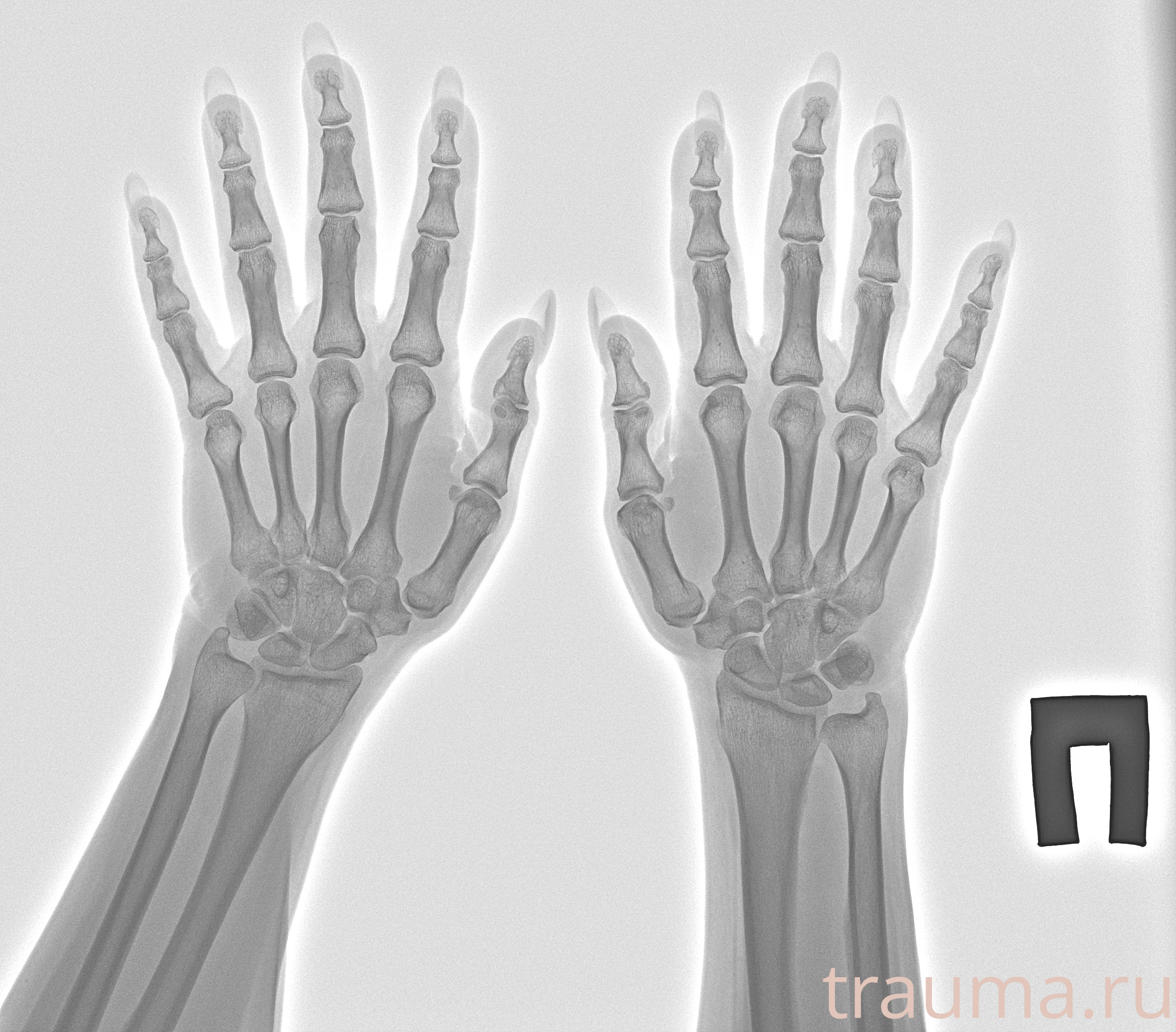 Рентген на дому: по вашему адресу приезжает врач-рентгенолог, травматолог-ортопед с мобильным рентгеновским аппаратом, проводит диагностику травмы или заболевания, делает необходимые рентгенограммы, дает рекомендации по дальнейшему лечению. Получить качественные снимки в домашних условиях возможно благодаря уникальной методике, разработанной МосРентген Центром для института  Склифосовского