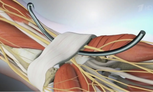 Результаты дифференцированного подхода к открытой декомпрессии срединного нерва при синдроме запястного канала