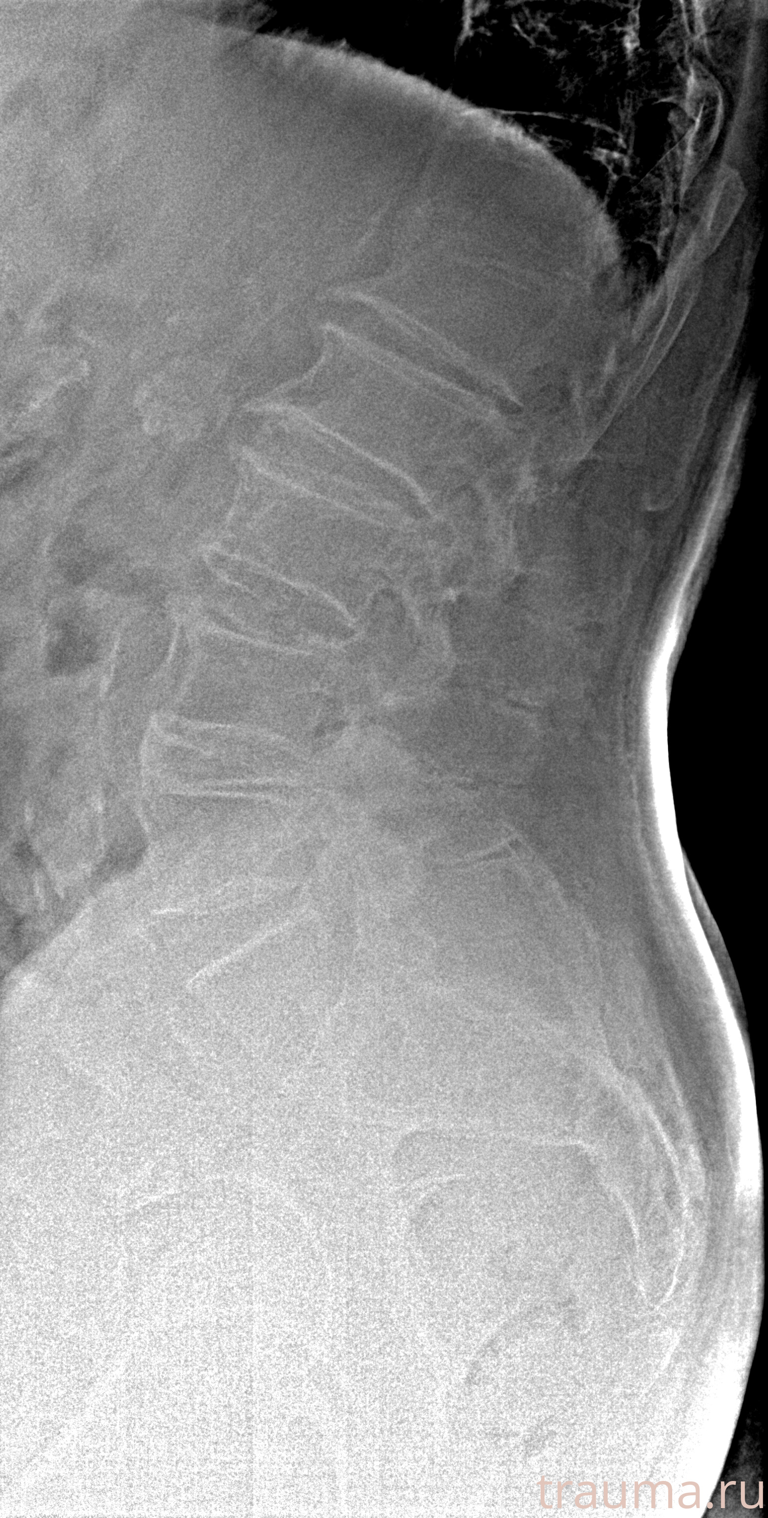 Рентген на дому: по вашему адресу приезжает врач-рентгенолог, травматолог-ортопед с мобильным рентгеновским аппаратом, проводит диагностику травмы или заболевания, делает необходимые рентгенограммы, дает рекомендации по дальнейшему лечению. Получить качественные снимки в домашних условиях возможно благодаря уникальной методике, разработанной МосРентген Центром для института  Склифосовского