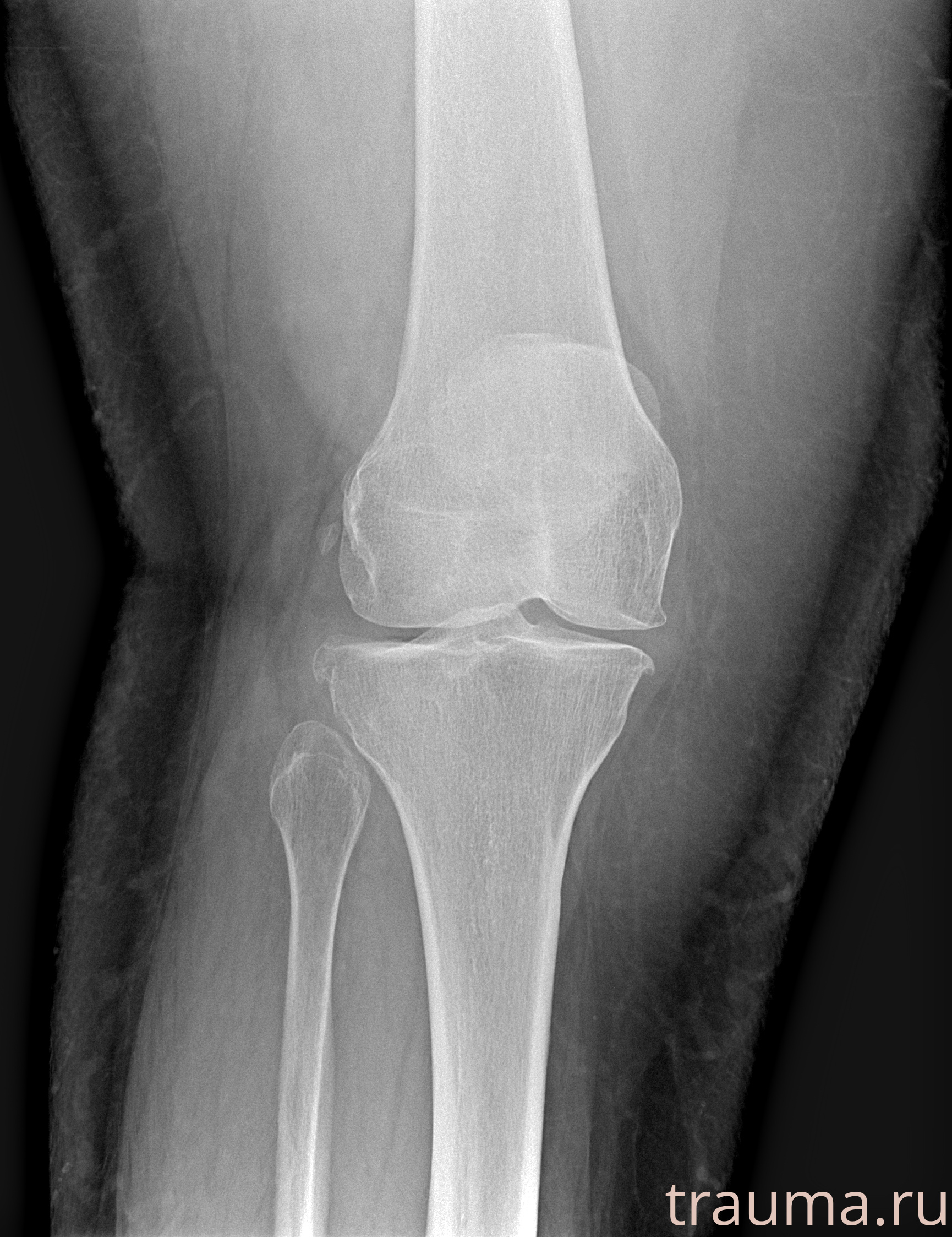 Рентген на дому: по вашему адресу приезжает врач-рентгенолог, травматолог-ортопед с мобильным рентгеновским аппаратом, проводит диагностику травмы или заболевания, делает необходимые рентгенограммы, дает рекомендации по дальнейшему лечению. Получить качественные снимки в домашних условиях возможно благодаря уникальной методике, разработанной МосРентген Центром для института  Склифосовского