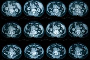 Поражение костей при лимфоме Ходжкина: возможности КТ и МРТ диагностики