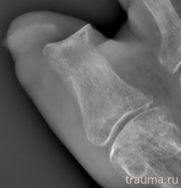 Рентген на дому: по вашему адресу приезжает врач-рентгенолог, травматолог-ортопед с мобильным рентгеновским аппаратом, проводит диагностику травмы или заболевания, делает необходимые рентгенограммы, дает рекомендации по дальнейшему лечению. Получить качественные снимки в домашних условиях возможно благодаря уникальной методике, разработанной МосРентген Центром для института  Склифосовского