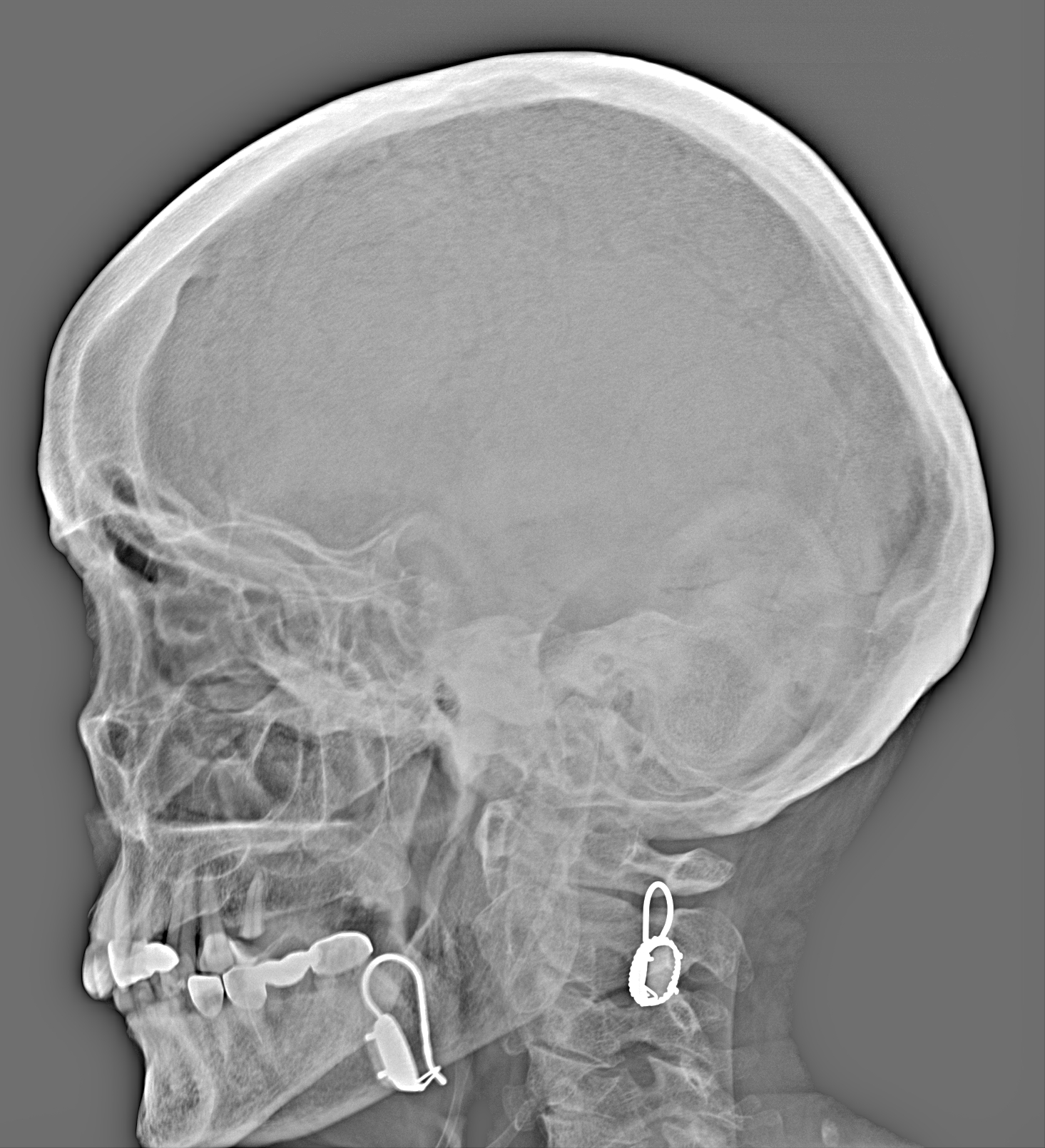Рентген на дому: по вашему адресу приезжает врач-рентгенолог, травматолог-ортопед с мобильным рентгеновским аппаратом, проводит диагностику травмы или заболевания, делает необходимые рентгенограммы, дает рекомендации по дальнейшему лечению. Получить качественные снимки в домашних условиях возможно благодаря уникальной методике, разработанной МосРентген Центром для института  Склифосовского