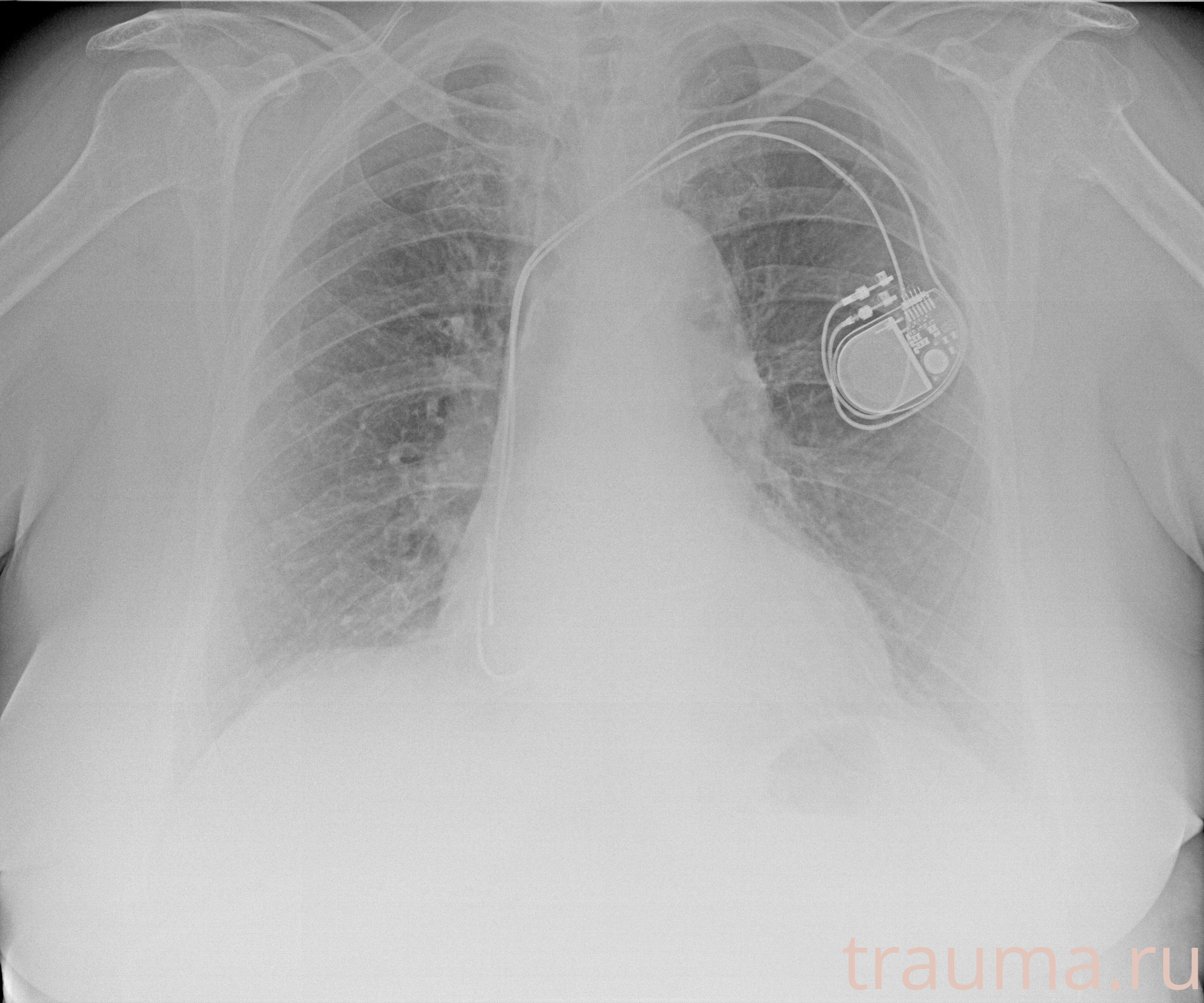 Рентген на дому: по вашему адресу приезжает врач-рентгенолог, травматолог-ортопед с мобильным рентгеновским аппаратом, проводит диагностику травмы или заболевания, делает необходимые рентгенограммы, дает рекомендации по дальнейшему лечению. Получить качественные снимки в домашних условиях возможно благодаря уникальной методике, разработанной МосРентген Центром для института  Склифосовского