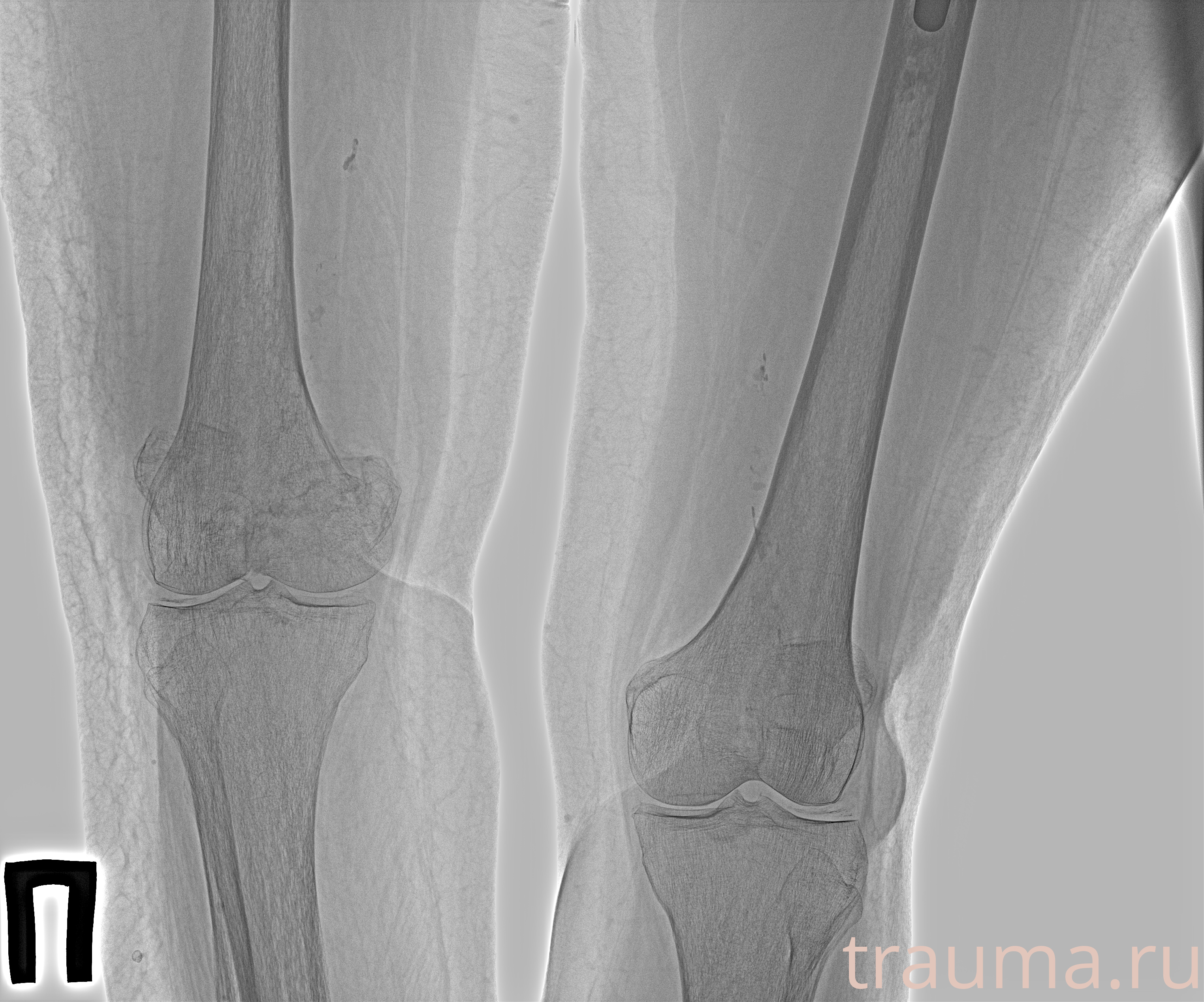 Рентген на дому: по вашему адресу приезжает врач-рентгенолог, травматолог-ортопед с мобильным рентгеновским аппаратом, проводит диагностику травмы или заболевания, делает необходимые рентгенограммы, дает рекомендации по дальнейшему лечению. Получить качественные снимки в домашних условиях возможно благодаря уникальной методике, разработанной МосРентген Центром для института  Склифосовского