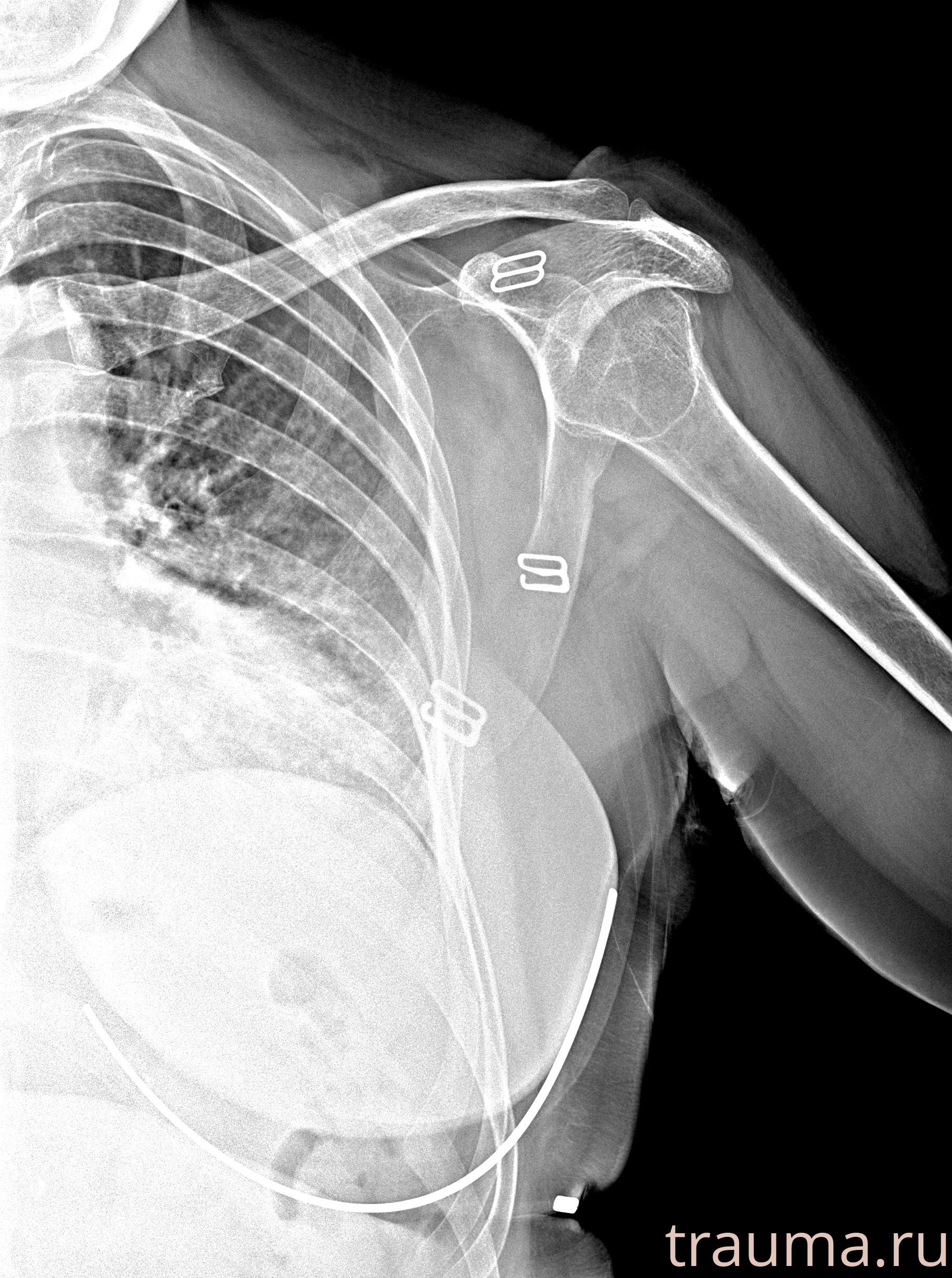 Рентген на дому: по вашему адресу приезжает врач-рентгенолог, травматолог-ортопед с мобильным рентгеновским аппаратом, проводит диагностику травмы или заболевания, делает необходимые рентгенограммы, дает рекомендации по дальнейшему лечению. Получить качественные снимки в домашних условиях возможно благодаря уникальной методике, разработанной МосРентген Центром для института  Склифосовского