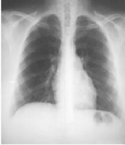 Рентгеноанатомические основы исследования легких. Рентгенологический анализ легких. Глава 24