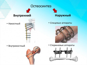 Осложнения при накостном остеосинтезе у больных  с переломами длинных трубчатых костей