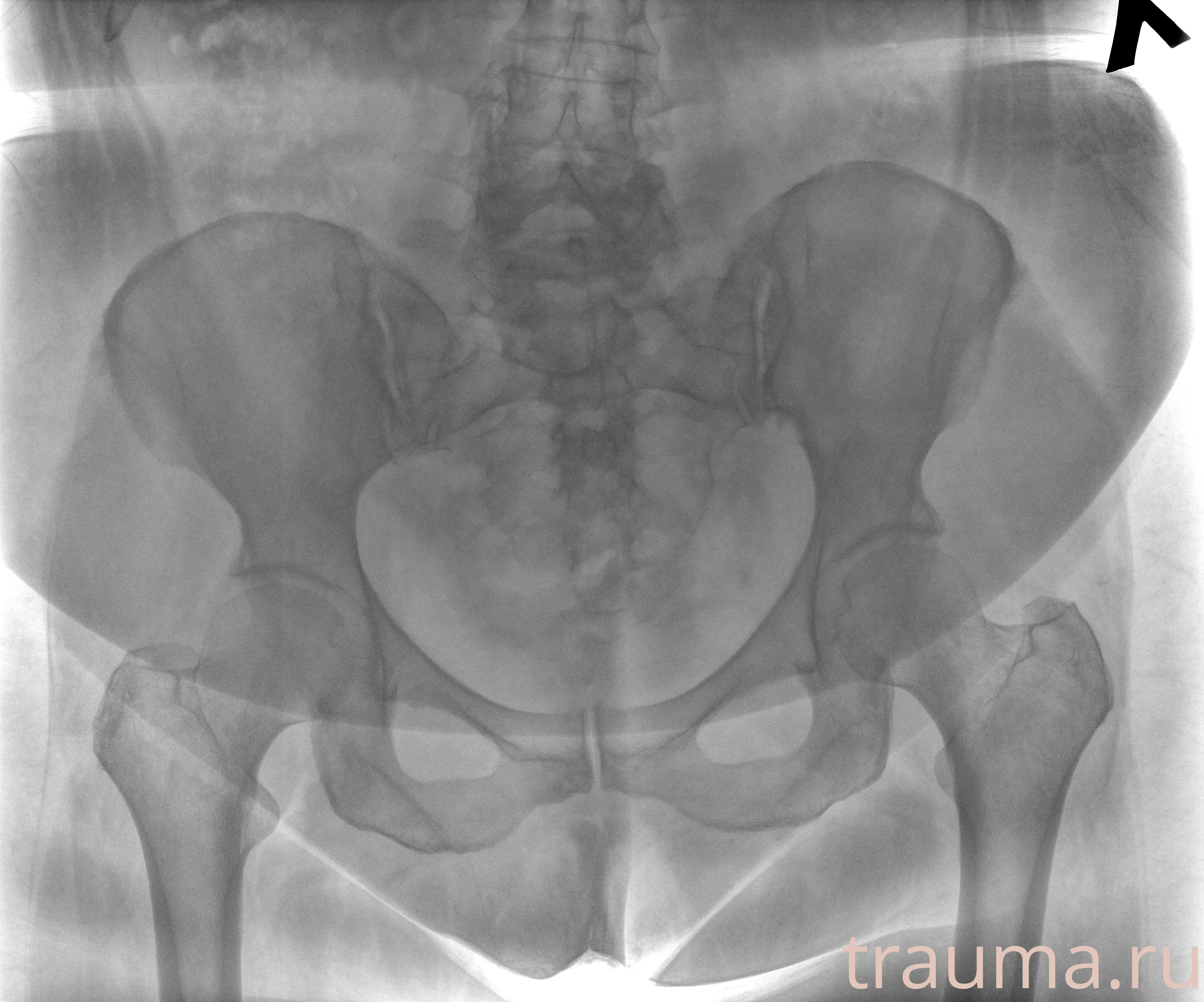 Рентген на дому: по вашему адресу приезжает врач-рентгенолог, травматолог-ортопед с мобильным рентгеновским аппаратом, проводит диагностику травмы или заболевания, делает необходимые рентгенограммы, дает рекомендации по дальнейшему лечению. Получить качественные снимки в домашних условиях возможно благодаря уникальной методике, разработанной МосРентген Центром для института  Склифосовского