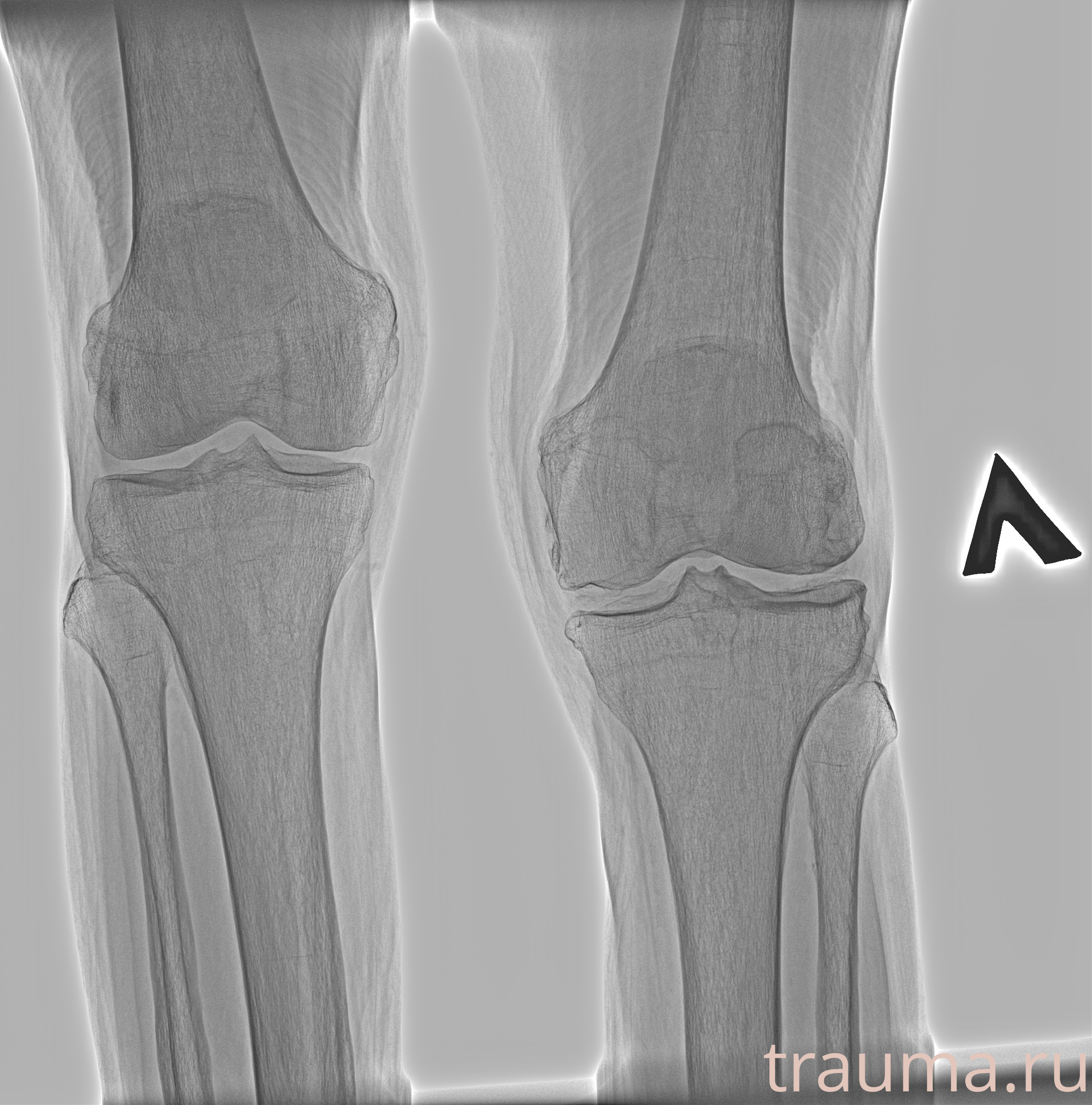 Рентген на дому: по вашему адресу приезжает врач-рентгенолог, травматолог-ортопед с мобильным рентгеновским аппаратом, проводит диагностику травмы или заболевания, делает необходимые рентгенограммы, дает рекомендации по дальнейшему лечению. Получить качественные снимки в домашних условиях возможно благодаря уникальной методике, разработанной МосРентген Центром для института  Склифосовского