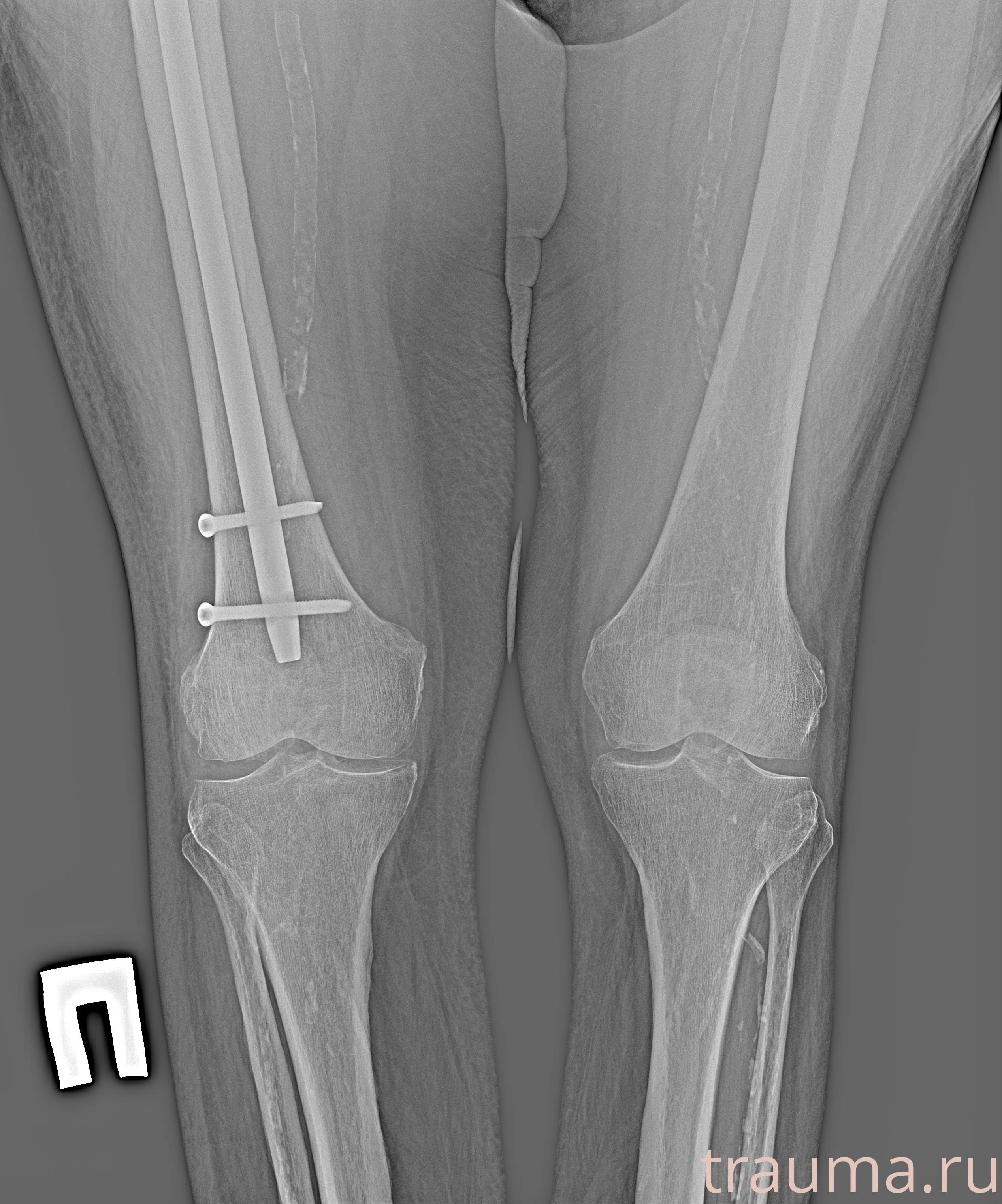 Рентген на дому: по вашему адресу приезжает врач-рентгенолог, травматолог-ортопед с мобильным рентгеновским аппаратом, проводит диагностику травмы или заболевания, делает необходимые рентгенограммы, дает рекомендации по дальнейшему лечению. Получить качественные снимки в домашних условиях возможно благодаря уникальной методике, разработанной МосРентген Центром для института  Склифосовского