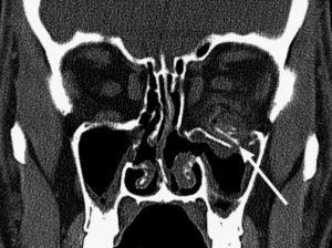 Рентгенодиагностика травматических повреждений нижней стенки глазницы