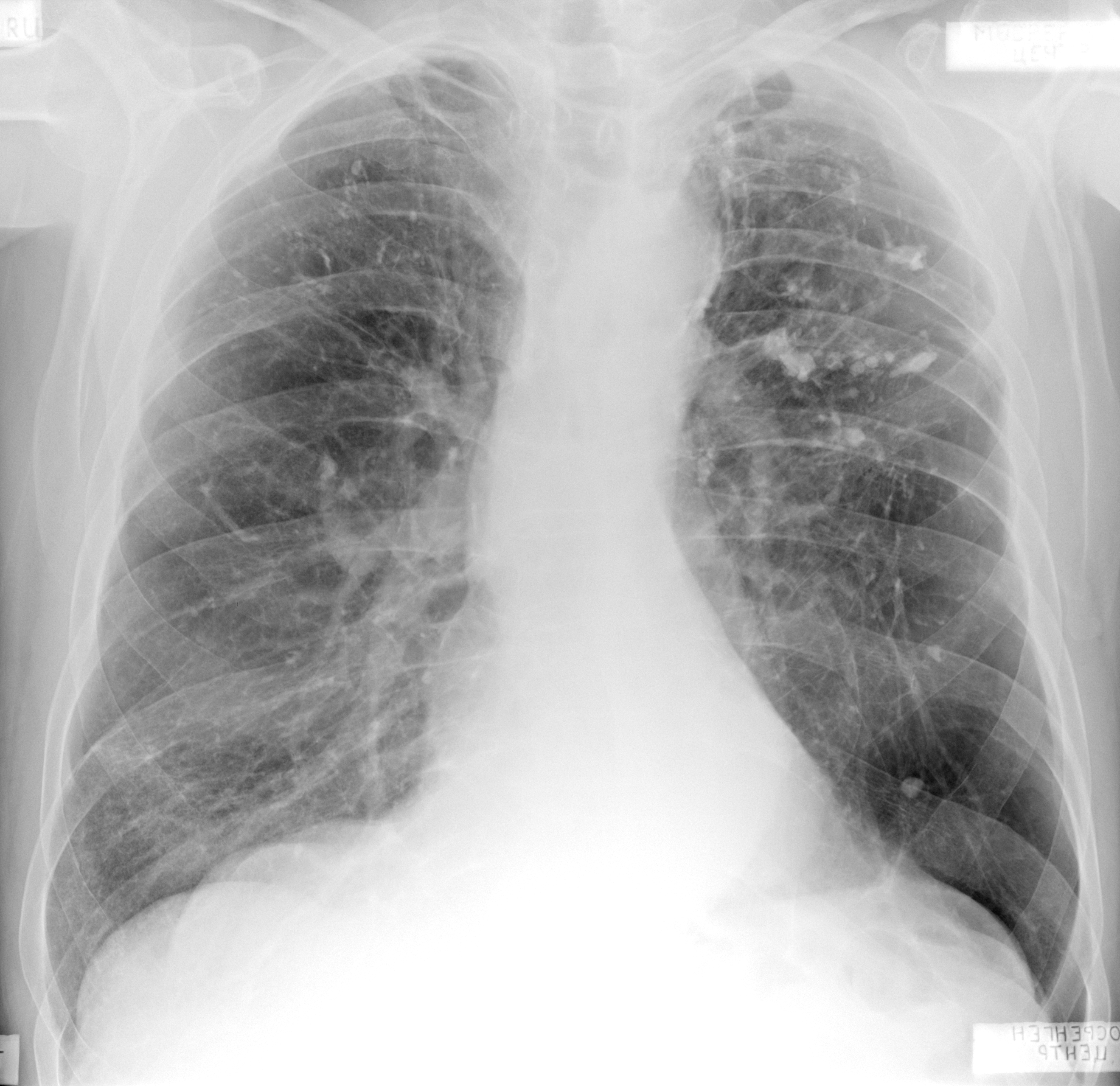 Вода в легких последствия. Пневмосклероз рентгенограмма. Рубцы на лёгких после пневмонии.