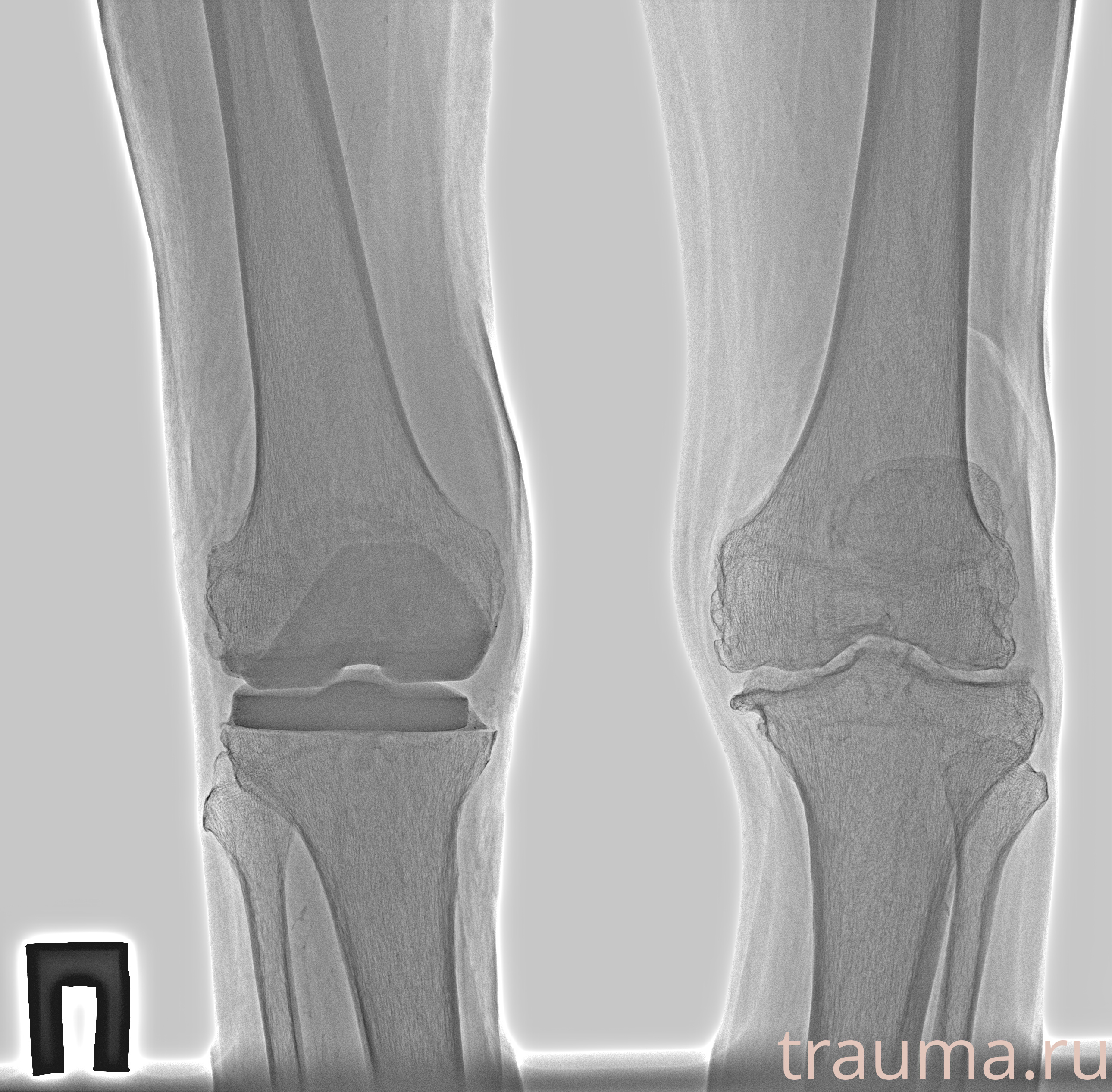 Рентген на дому: по вашему адресу приезжает врач-рентгенолог, травматолог-ортопед с мобильным рентгеновским аппаратом, проводит диагностику травмы или заболевания, делает необходимые рентгенограммы, дает рекомендации по дальнейшему лечению. Получить качественные снимки в домашних условиях возможно благодаря уникальной методике, разработанной МосРентген Центром для института  Склифосовского