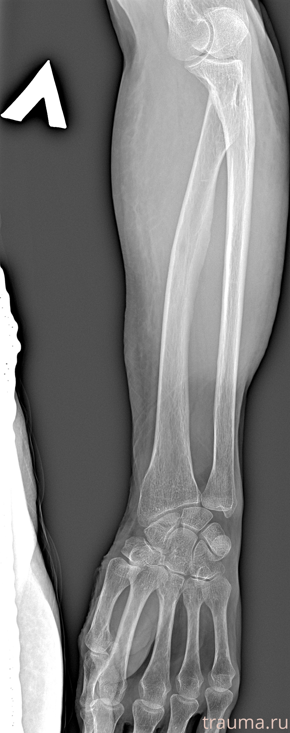 Рентген на дому: по вашему адресу приезжает врач-рентгенолог, травматолог-ортопед с мобильным рентгеновским аппаратом, проводит диагностику травмы или заболевания, делает необходимые рентгенограммы, дает рекомендации по дальнейшему лечению. Получить качественные снимки в домашних условиях возможно благодаря уникальной методике, разработанной МосРентген Центром для института  Склифосовского
