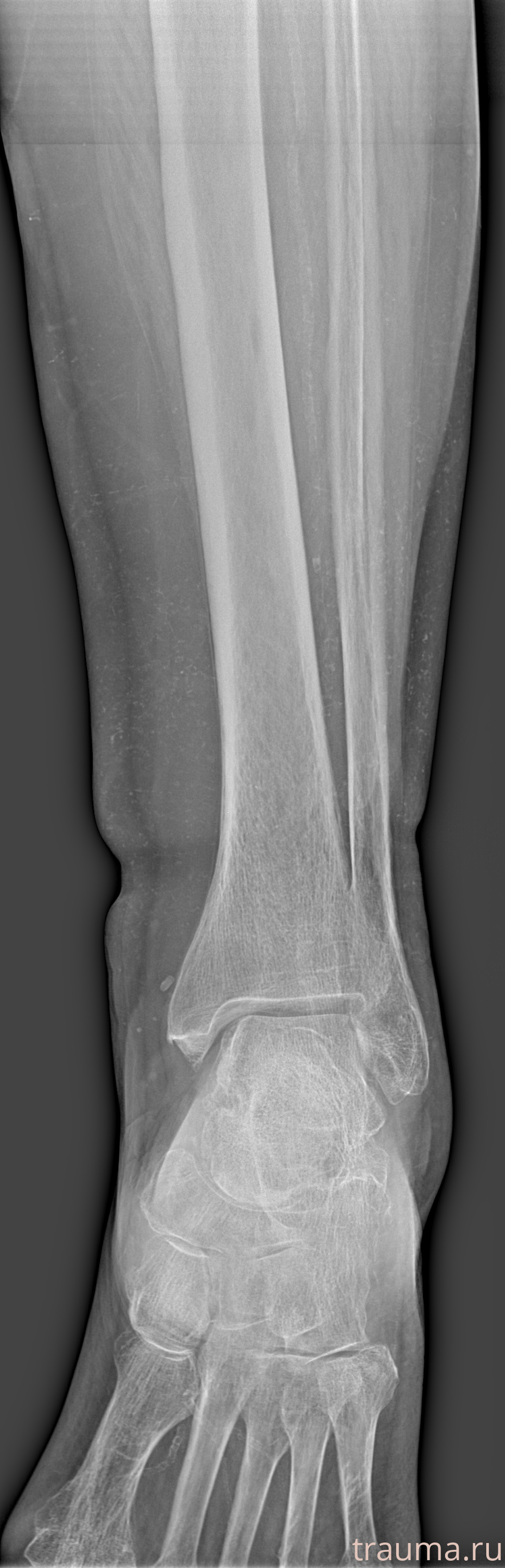 Рентген на дому: по вашему адресу приезжает врач-рентгенолог, травматолог-ортопед с мобильным рентгеновским аппаратом, проводит диагностику травмы или заболевания, делает необходимые рентгенограммы, дает рекомендации по дальнейшему лечению. Получить качественные снимки в домашних условиях возможно благодаря уникальной методике, разработанной МосРентген Центром для института  Склифосовского