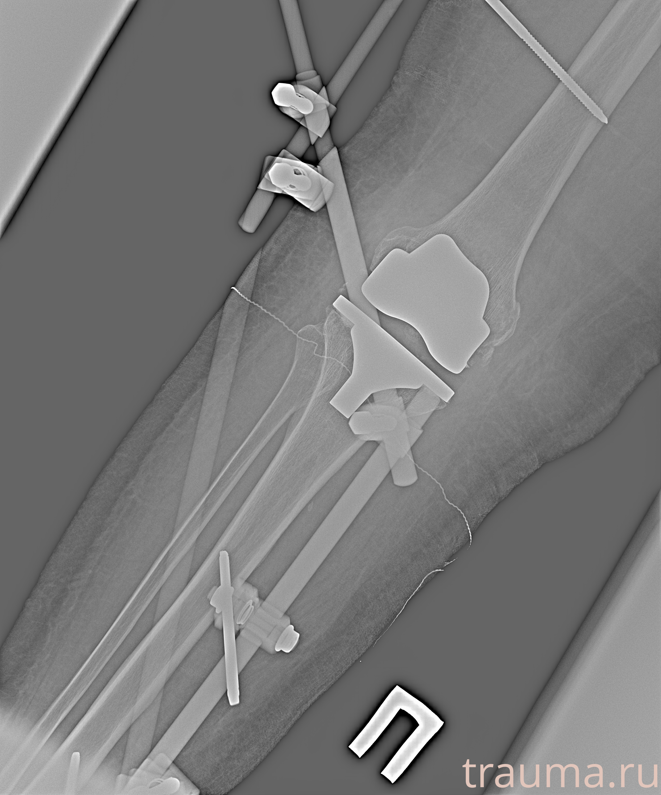 Рентген на дому: по вашему адресу приезжает врач-рентгенолог, травматолог-ортопед с мобильным рентгеновским аппаратом, проводит диагностику травмы или заболевания, делает необходимые рентгенограммы, дает рекомендации по дальнейшему лечению. Получить качественные снимки в домашних условиях возможно благодаря уникальной методике, разработанной МосРентген Центром для института  Склифосовского