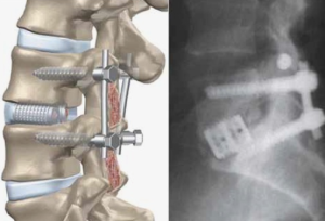 Лечение посттравматического поясничного кифоза с использованием многоуровневой остеотомии понте и заднего спондилодеза: клинический опыт