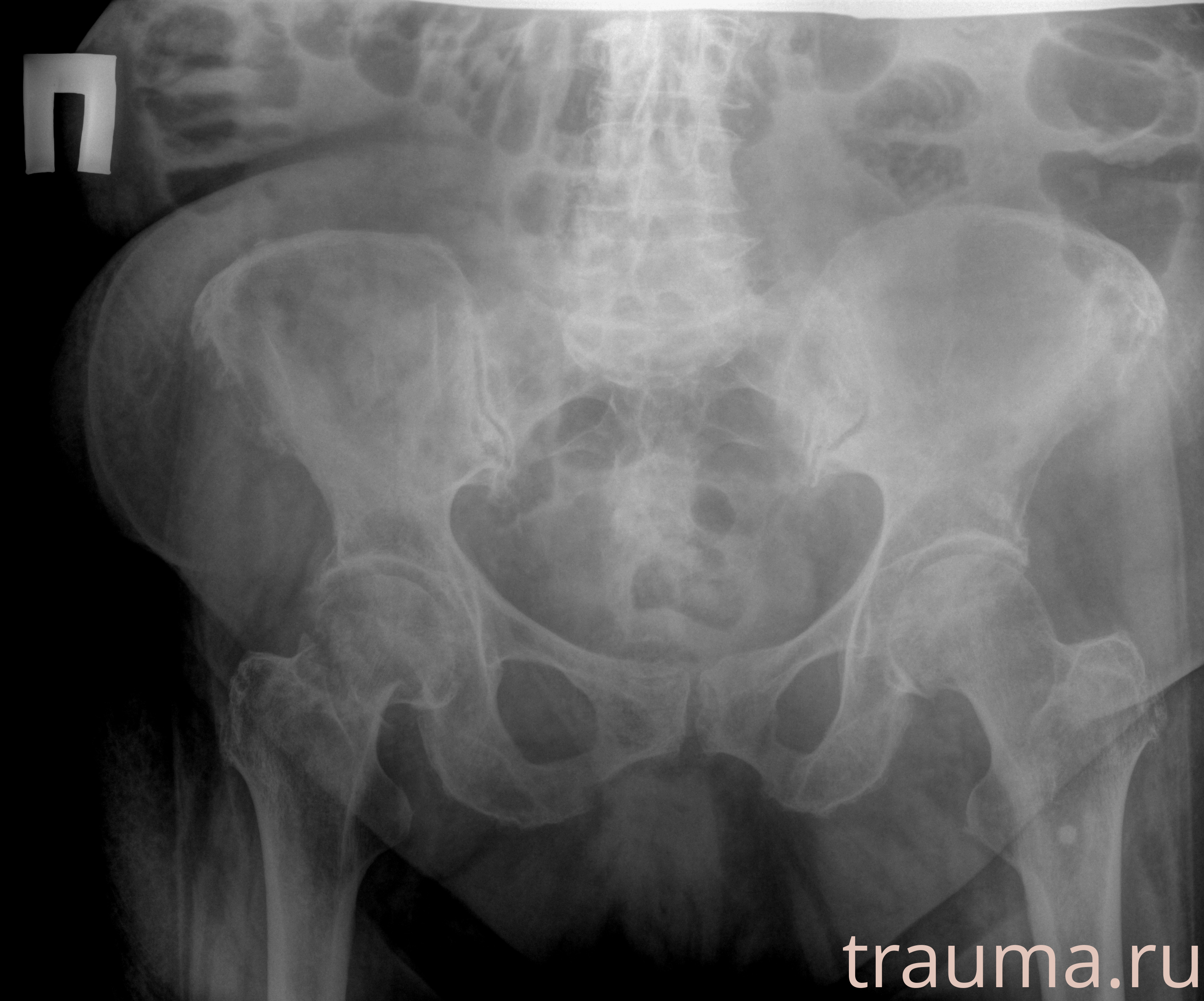 Рентген на дому: по вашему адресу приезжает врач-рентгенолог, травматолог-ортопед с мобильным рентгеновским аппаратом, проводит диагностику травмы или заболевания, делает необходимые рентгенограммы, дает рекомендации по дальнейшему лечению. Получить качественные снимки в домашних условиях возможно благодаря уникальной методике, разработанной МосРентген Центром для института  Склифосовского