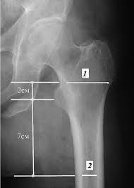 Возможности рентгеновских методик в оценке изменений тазобедренных суставов до и после эндопротезирования