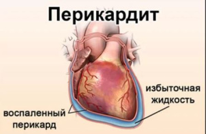 Курс медицинской рентгенологии.Рентгенологическое исследование органов кровообращения(сердца и больших сосудов).Часть 2. Глава 8.7