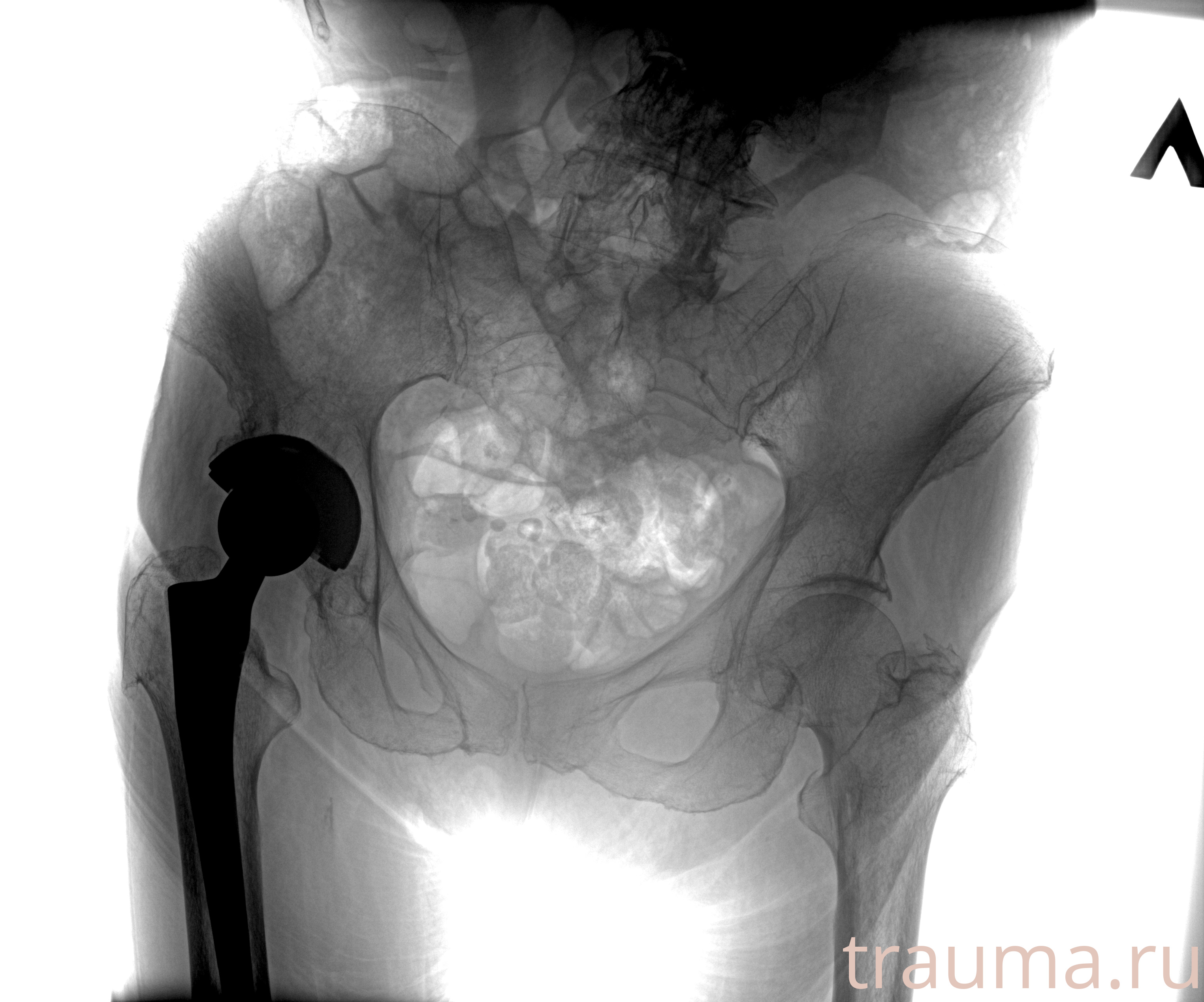 Рентген на дому: по вашему адресу приезжает врач-рентгенолог, травматолог-ортопед с мобильным рентгеновским аппаратом, проводит диагностику травмы или заболевания, делает необходимые рентгенограммы, дает рекомендации по дальнейшему лечению. Получить качественные снимки в домашних условиях возможно благодаря уникальной методике, разработанной МосРентген Центром для института  Склифосовского