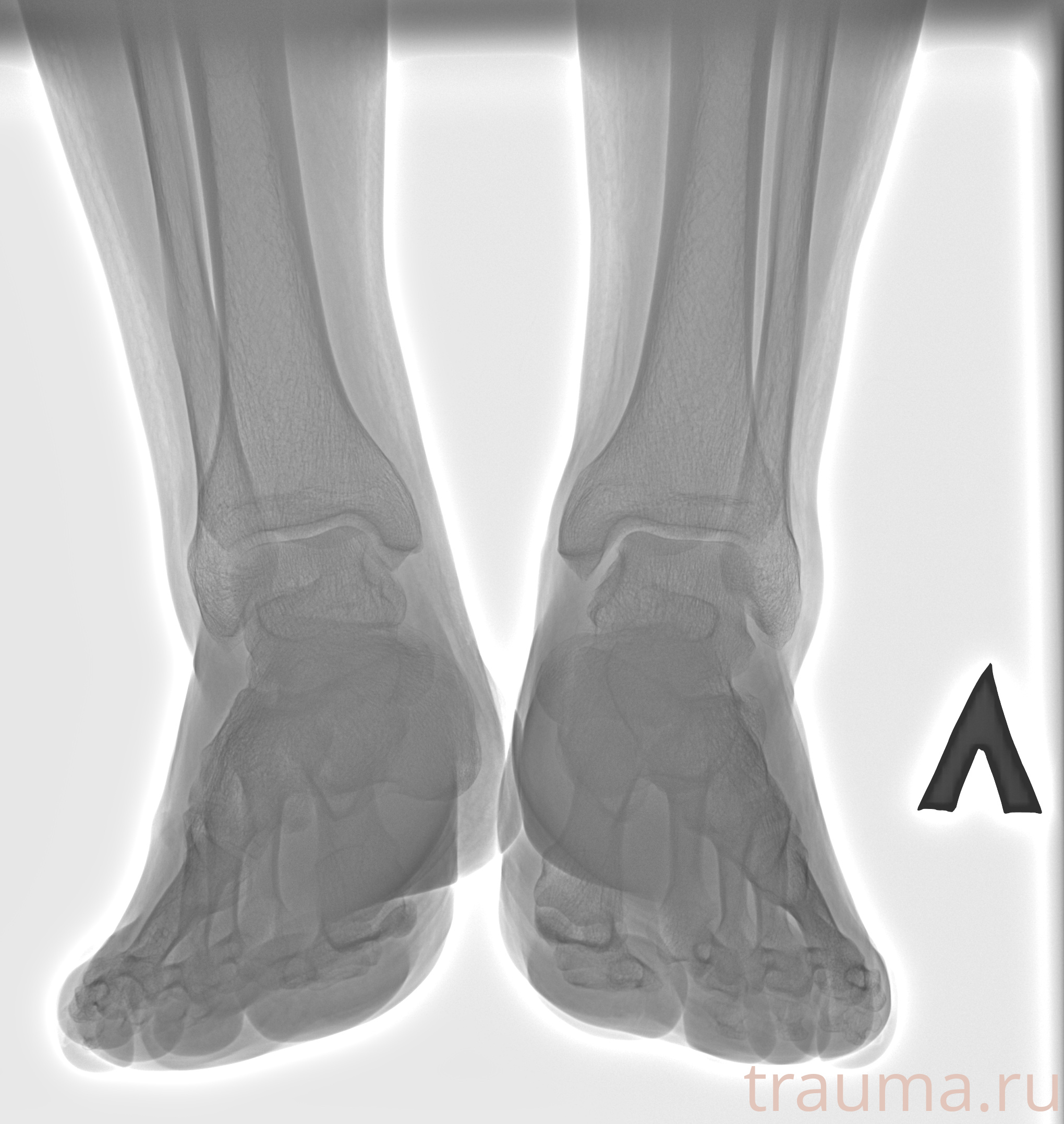 Рентген на дому: по вашему адресу приезжает врач-рентгенолог, травматолог-ортопед с мобильным рентгеновским аппаратом, проводит диагностику травмы или заболевания, делает необходимые рентгенограммы, дает рекомендации по дальнейшему лечению. Получить качественные снимки в домашних условиях возможно благодаря уникальной методике, разработанной МосРентген Центром для института  Склифосовского