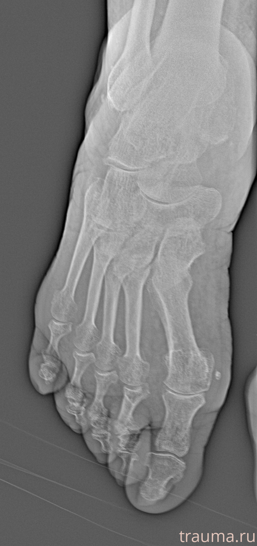 Рентген на дому: по вашему адресу приезжает врач-рентгенолог, травматолог-ортопед с мобильным рентгеновским аппаратом, проводит диагностику травмы или заболевания, делает необходимые рентгенограммы, дает рекомендации по дальнейшему лечению. Получить качественные снимки в домашних условиях возможно благодаря уникальной методике, разработанной МосРентген Центром для института  Склифосовского