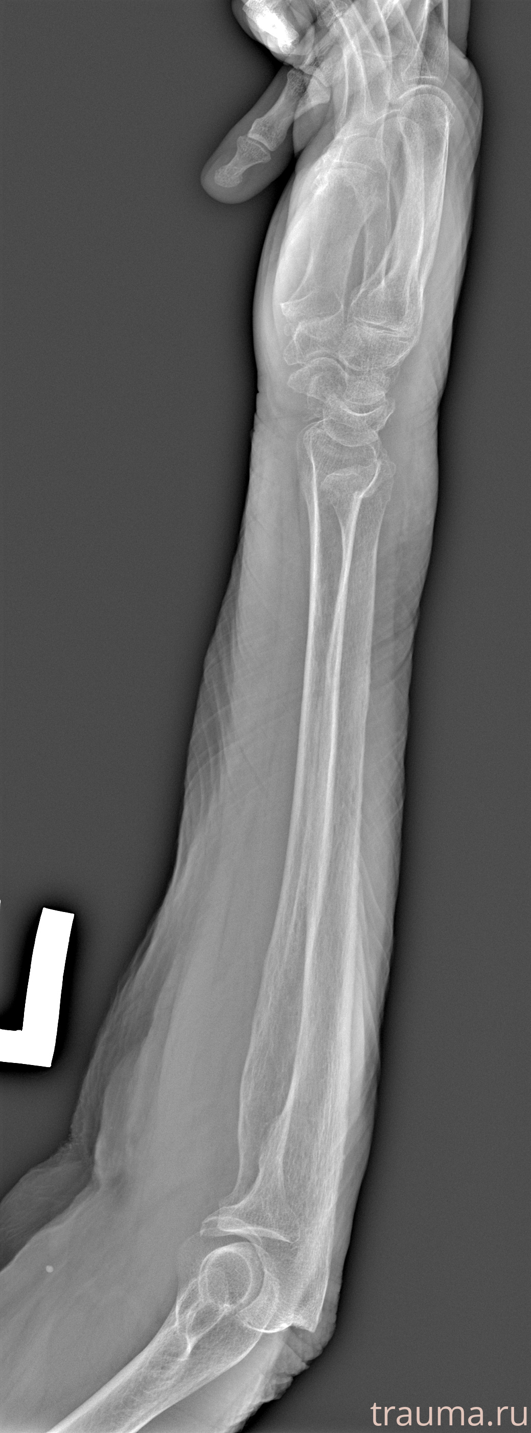 Рентген на дому: по вашему адресу приезжает врач-рентгенолог, травматолог-ортопед с мобильным рентгеновским аппаратом, проводит диагностику травмы или заболевания, делает необходимые рентгенограммы, дает рекомендации по дальнейшему лечению. Получить качественные снимки в домашних условиях возможно благодаря уникальной методике, разработанной МосРентген Центром для института  Склифосовского