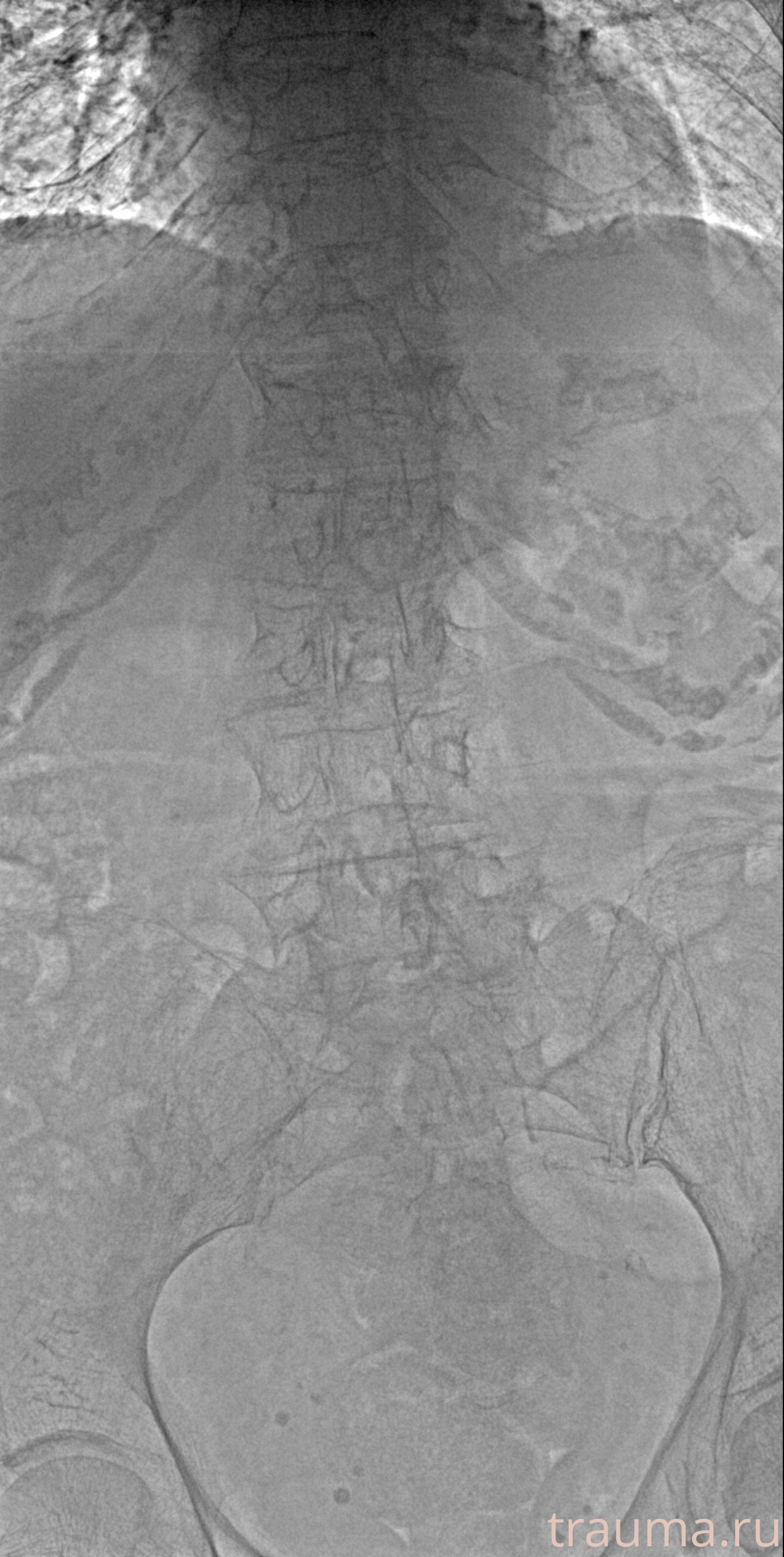 Рентген на дому: по вашему адресу приезжает врач-рентгенолог, травматолог-ортопед с мобильным рентгеновским аппаратом, проводит диагностику травмы или заболевания, делает необходимые рентгенограммы, дает рекомендации по дальнейшему лечению. Получить качественные снимки в домашних условиях возможно благодаря уникальной методике, разработанной МосРентген Центром для института  Склифосовского