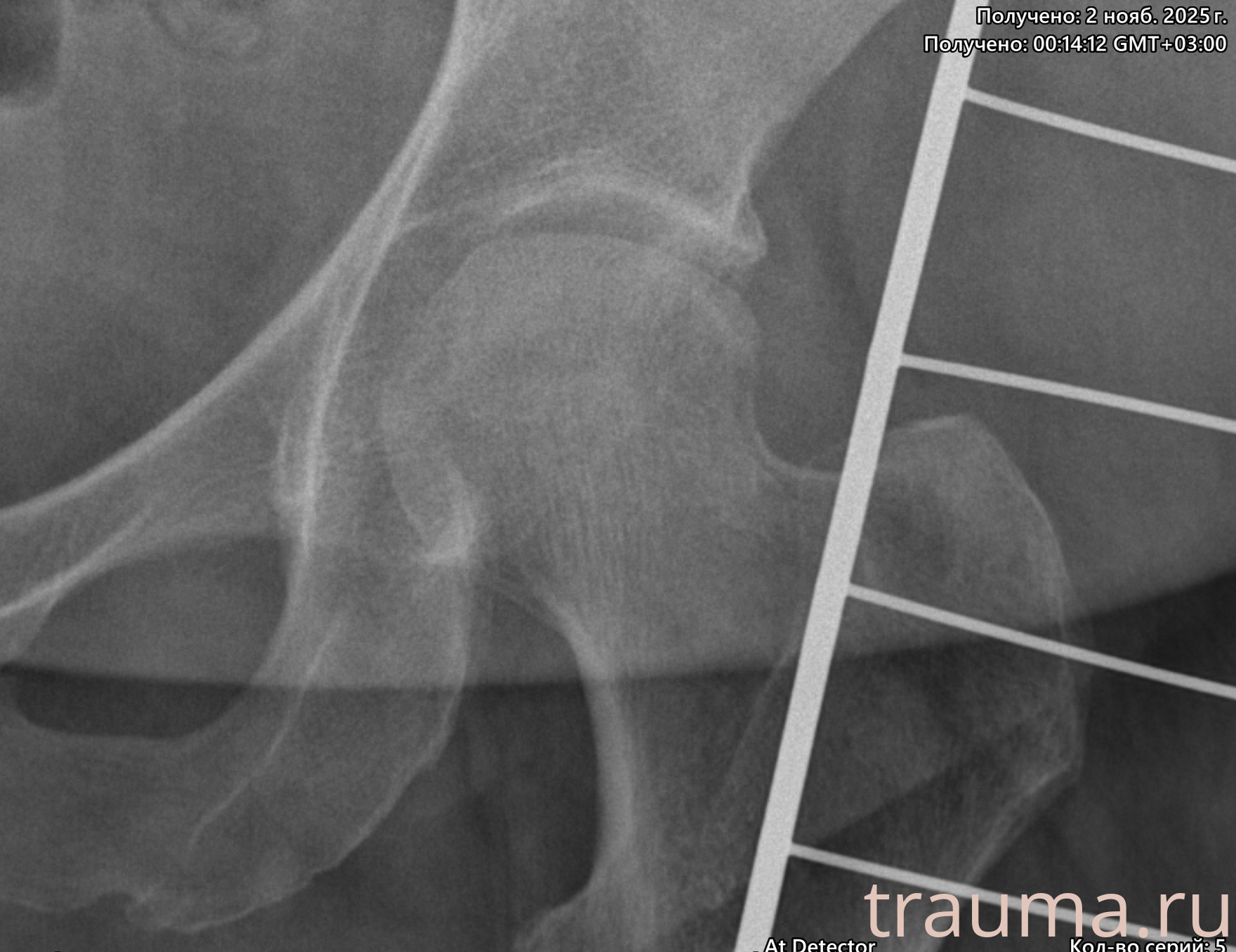 Рентген на дому: по вашему адресу приезжает врач-рентгенолог, травматолог-ортопед с мобильным рентгеновским аппаратом, проводит диагностику травмы или заболевания, делает необходимые рентгенограммы, дает рекомендации по дальнейшему лечению. Получить качественные снимки в домашних условиях возможно благодаря уникальной методике, разработанной МосРентген Центром для института  Склифосовского