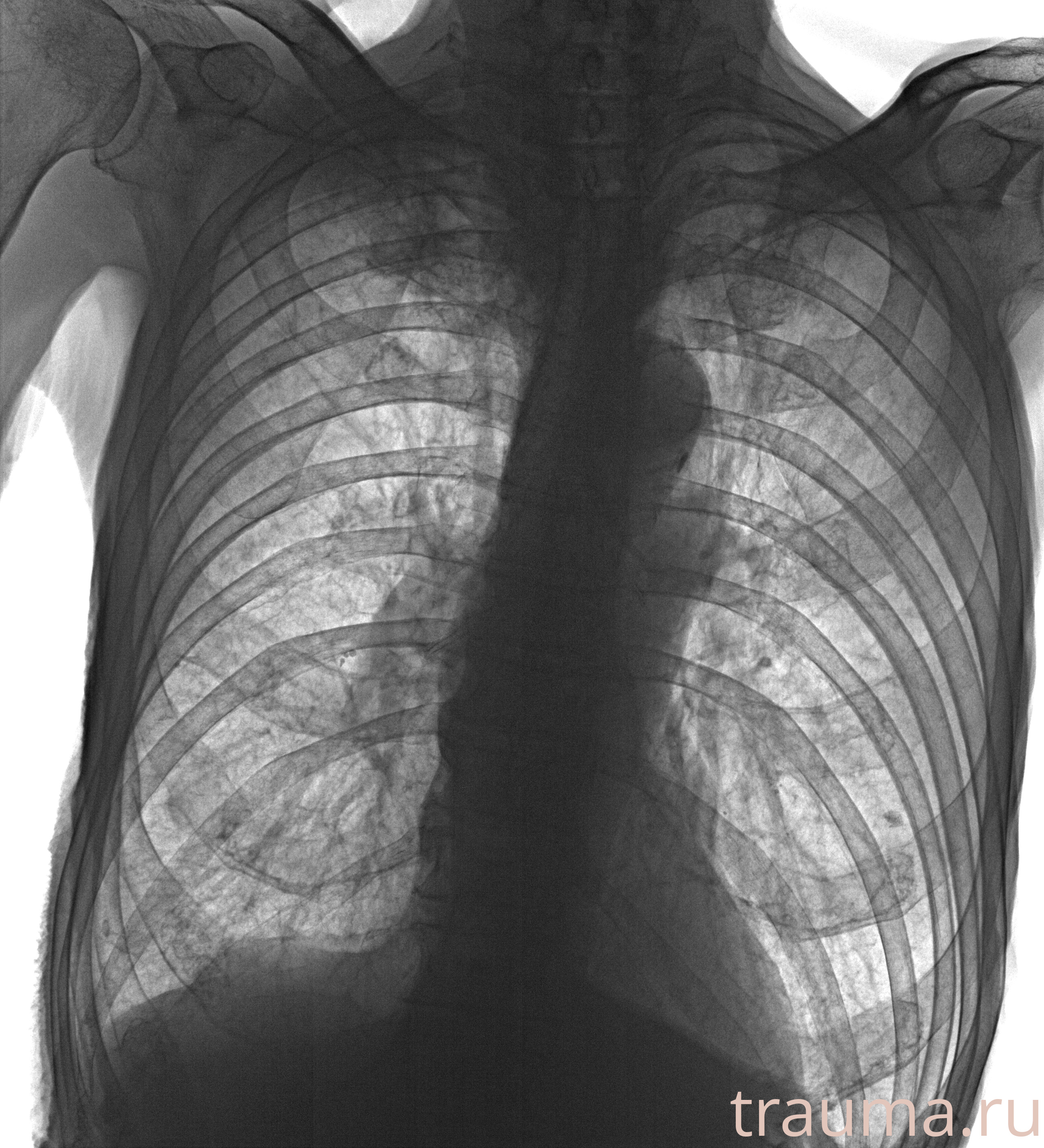 Рентген на дому: по вашему адресу приезжает врач-рентгенолог, травматолог-ортопед с мобильным рентгеновским аппаратом, проводит диагностику травмы или заболевания, делает необходимые рентгенограммы, дает рекомендации по дальнейшему лечению. Получить качественные снимки в домашних условиях возможно благодаря уникальной методике, разработанной МосРентген Центром для института  Склифосовского