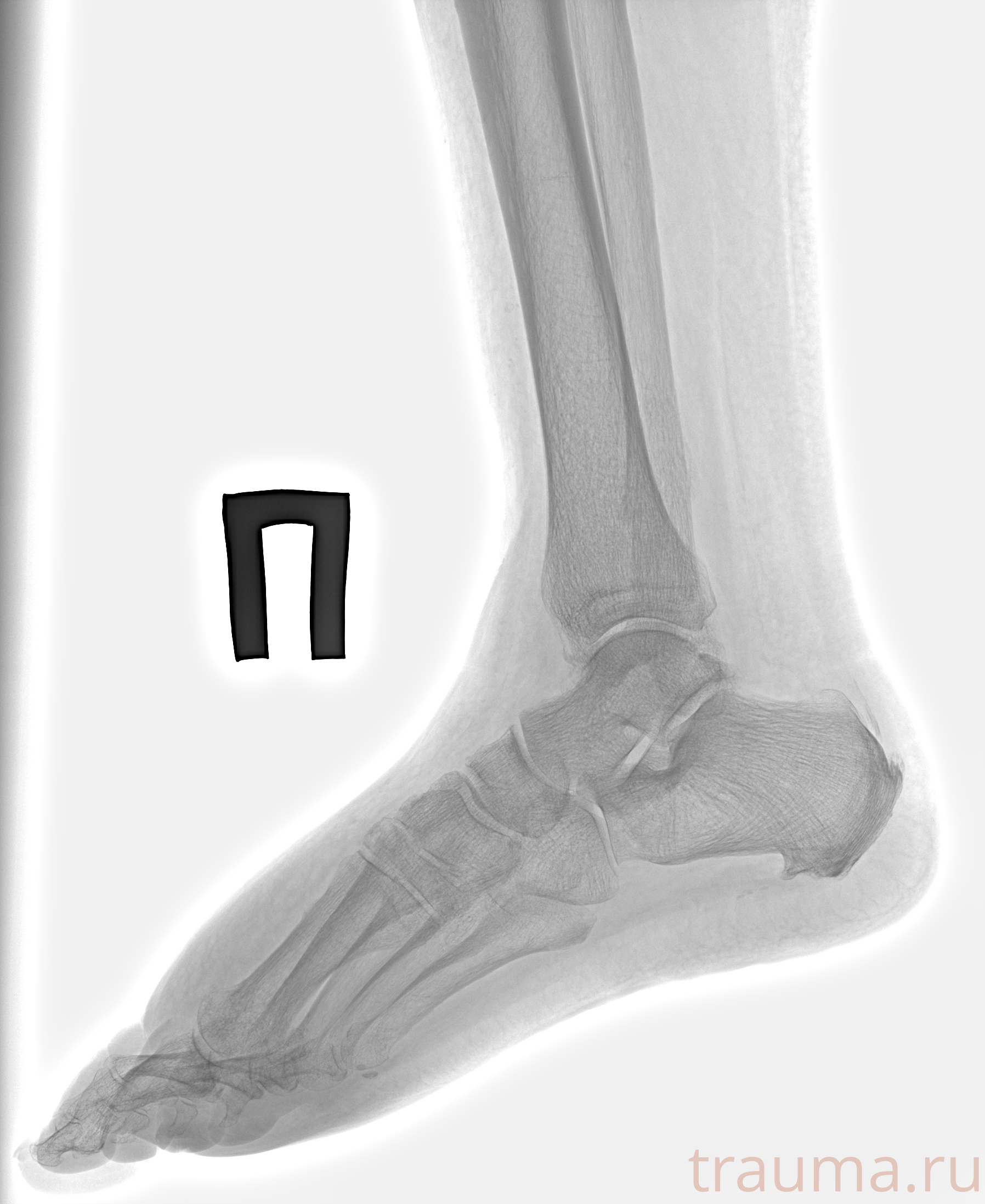 Рентген на дому: по вашему адресу приезжает врач-рентгенолог, травматолог-ортопед с мобильным рентгеновским аппаратом, проводит диагностику травмы или заболевания, делает необходимые рентгенограммы, дает рекомендации по дальнейшему лечению. Получить качественные снимки в домашних условиях возможно благодаря уникальной методике, разработанной МосРентген Центром для института  Склифосовского