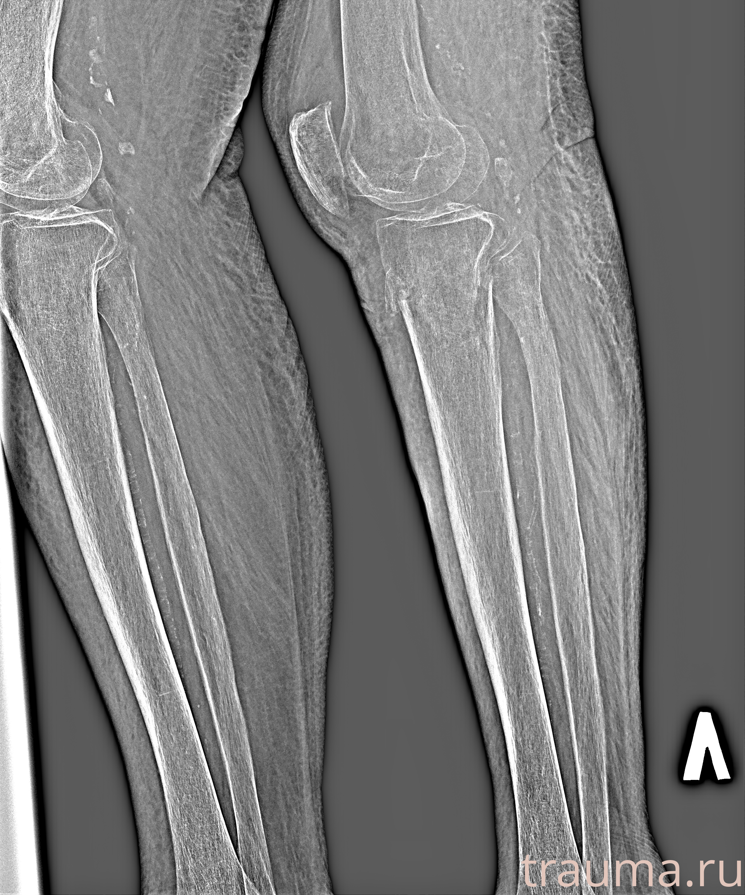 Рентген на дому: по вашему адресу приезжает врач-рентгенолог, травматолог-ортопед с мобильным рентгеновским аппаратом, проводит диагностику травмы или заболевания, делает необходимые рентгенограммы, дает рекомендации по дальнейшему лечению. Получить качественные снимки в домашних условиях возможно благодаря уникальной методике, разработанной МосРентген Центром для института  Склифосовского