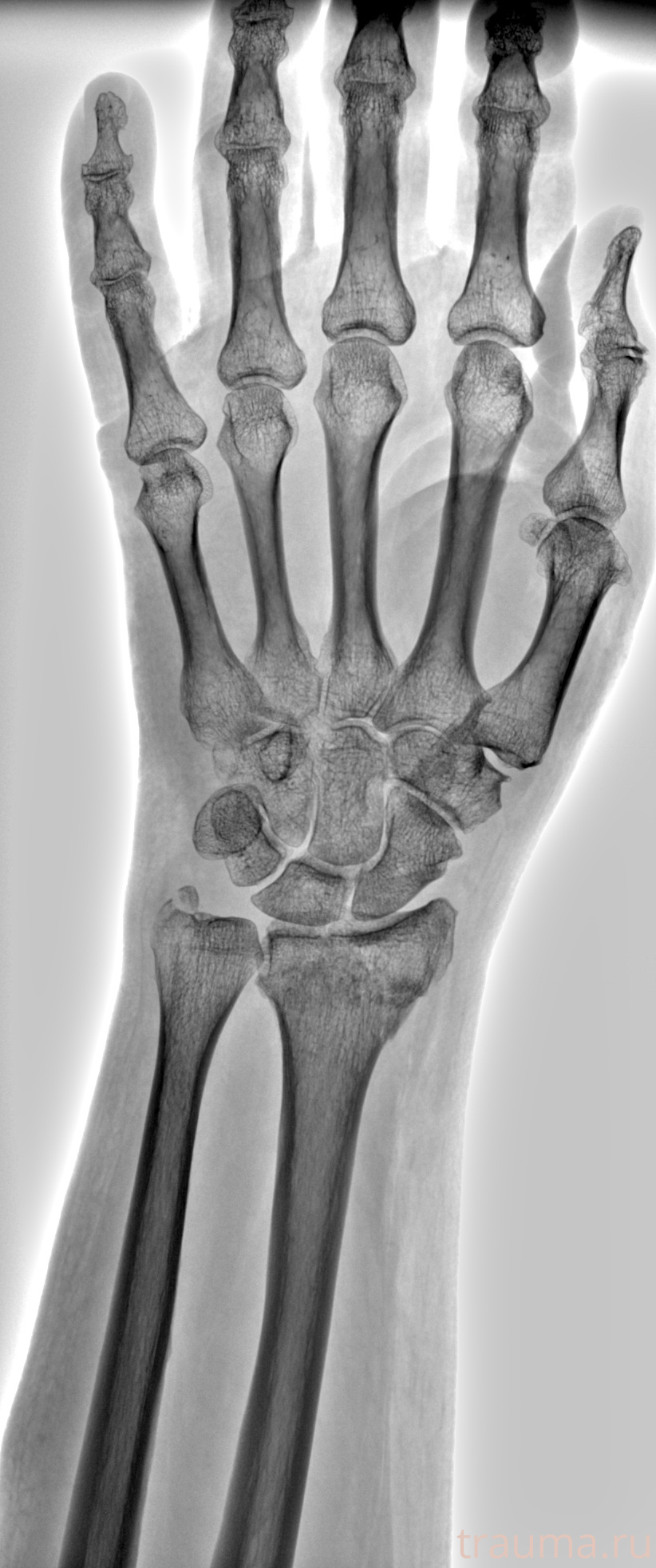 Рентген на дому: по вашему адресу приезжает врач-рентгенолог, травматолог-ортопед с мобильным рентгеновским аппаратом, проводит диагностику травмы или заболевания, делает необходимые рентгенограммы, дает рекомендации по дальнейшему лечению. Получить качественные снимки в домашних условиях возможно благодаря уникальной методике, разработанной МосРентген Центром для института  Склифосовского